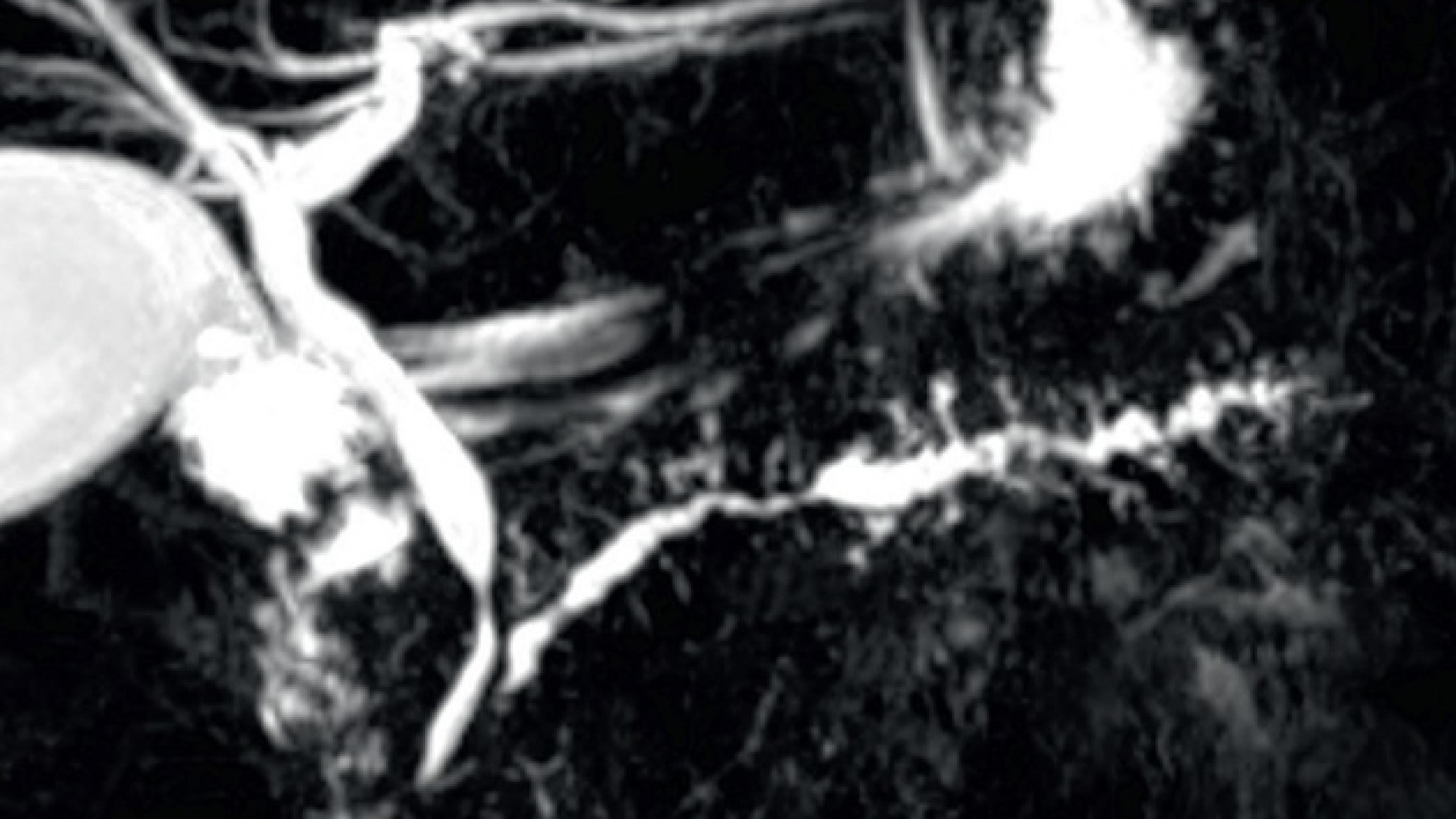 MR-kolangiopankreatikografi. Der ses udtalte forandringer i ductus pancreaticus.
