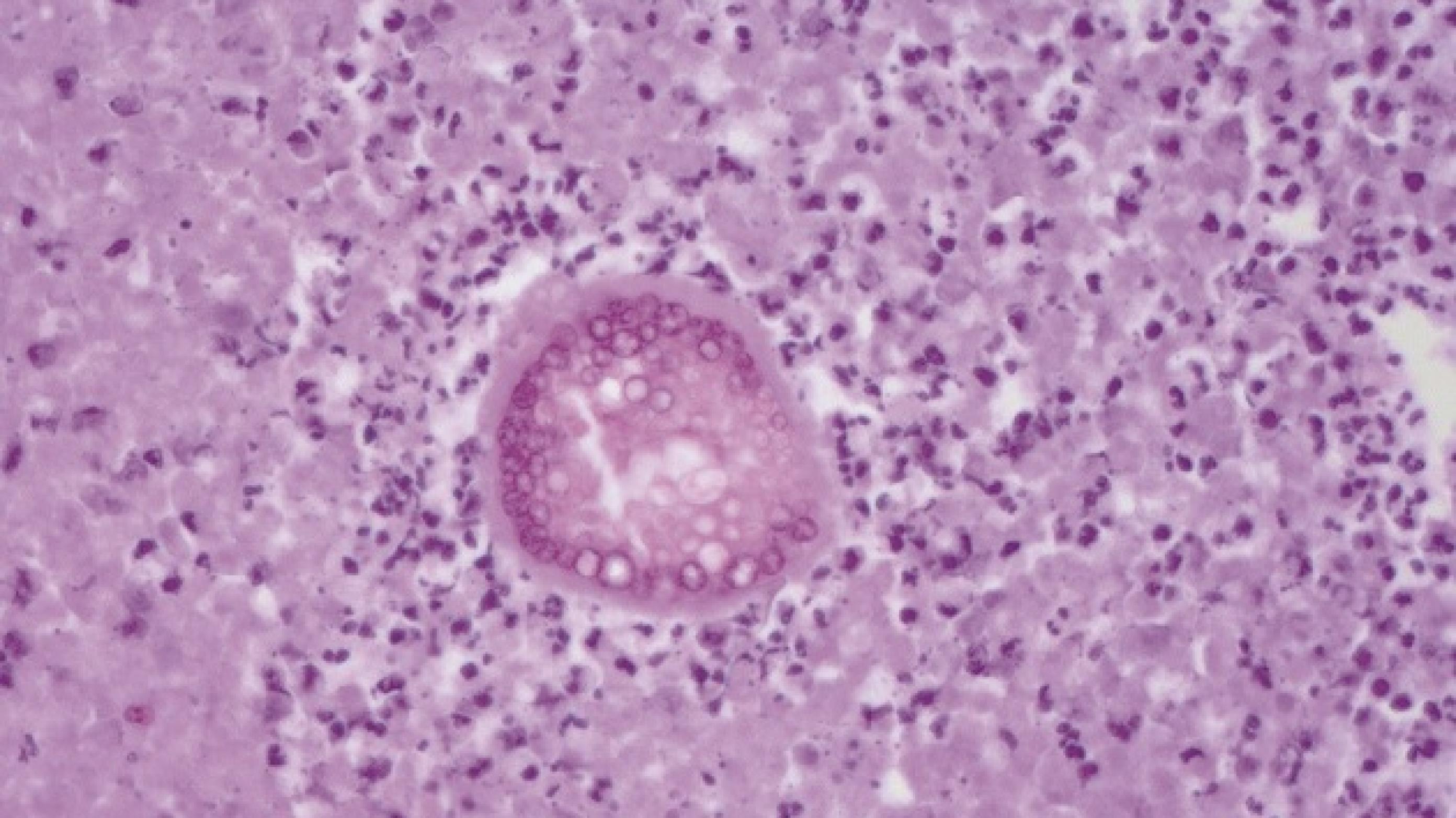 Perjodsyre-Schiff-farvet histologisk præparat fra meninges. Der ses en karakteristisk sferule fyldt med endosporer..