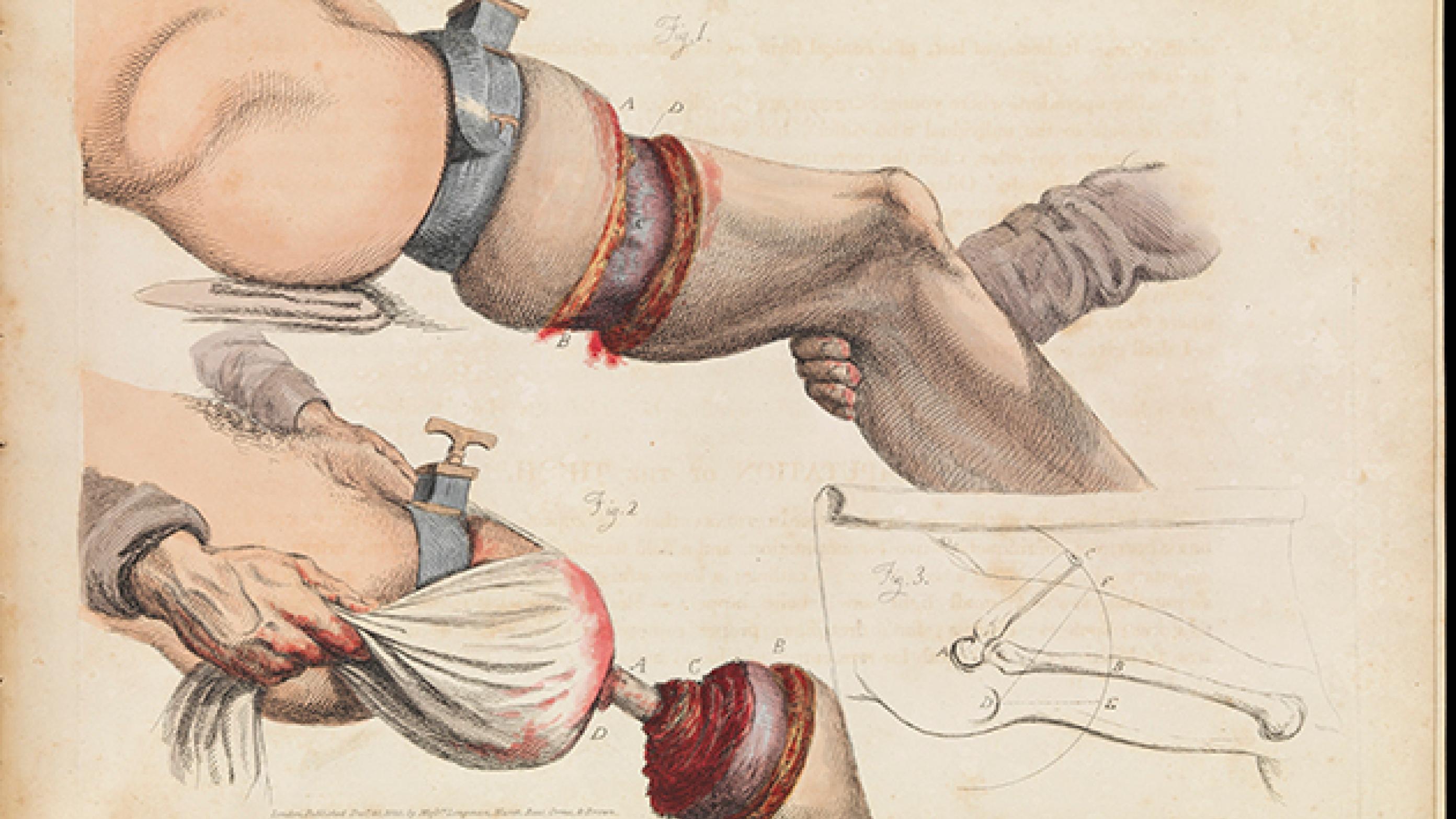 Kirurgisk planche fra 1800-tallet viser en låramputation. (The Wellcome Collection)