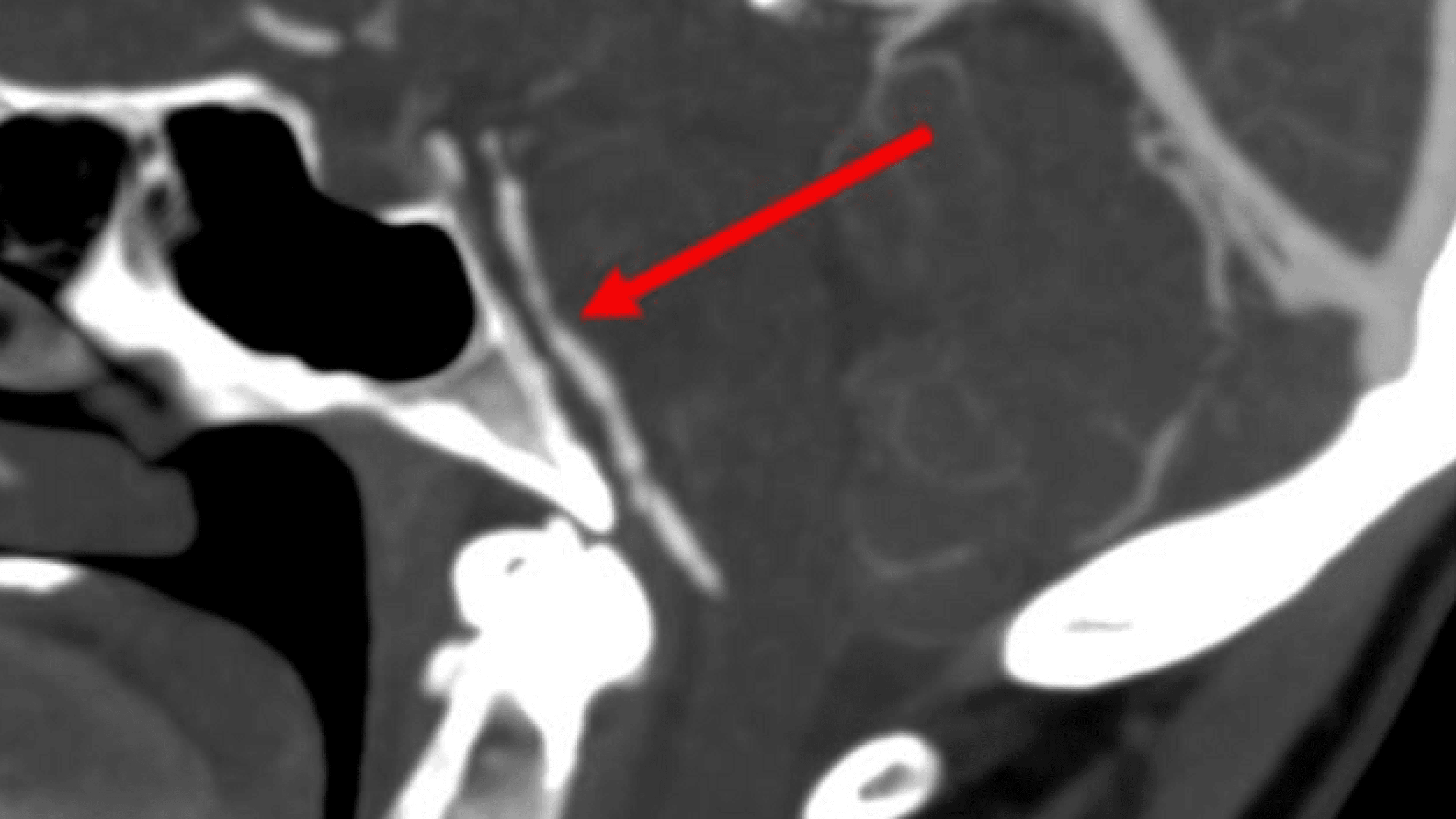 Sagittalt snit af arteria basilaris med karspasmer (pil). Tegnet kaldes »perler på en snor« og er klassisk for reversibelt cerebralt vasokonstriktionssyndrom.