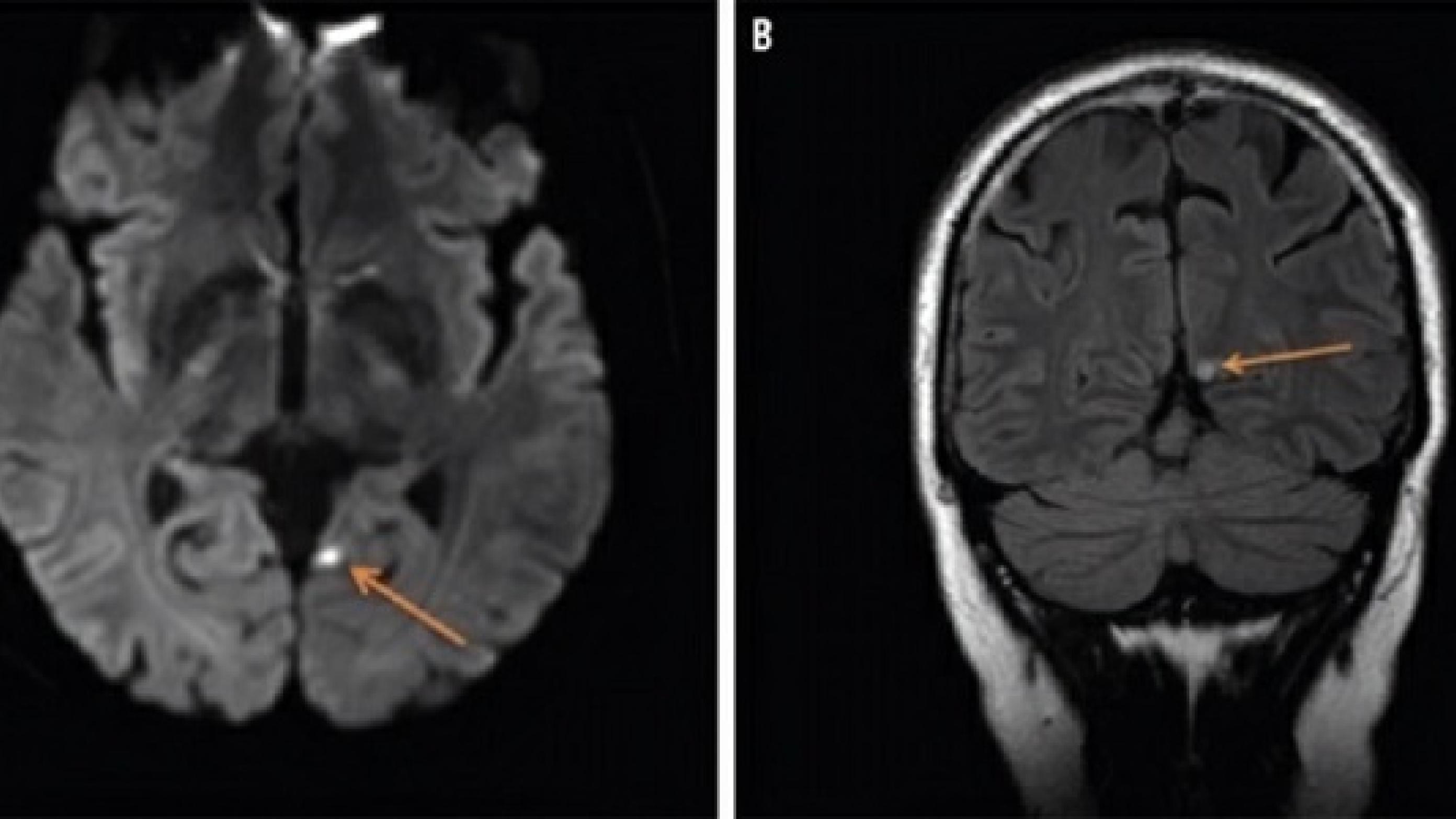 MR-skanningsbillede af en hjerne med et subakut iskæmisk infarkt i venstre praecuneus.