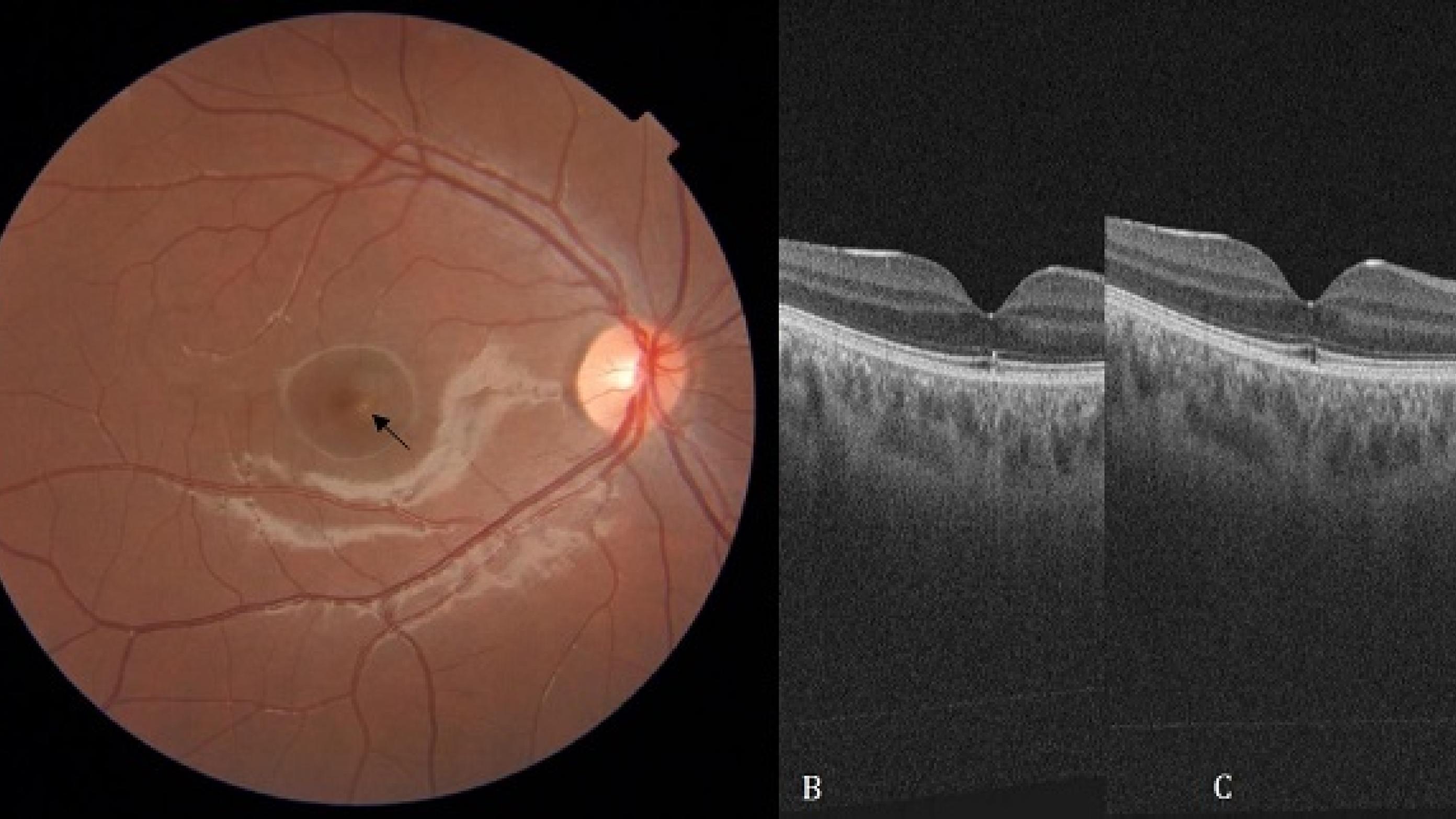 A. Fundusfoto af højre øje. B. Optical Coherence Tomography billede ved første undersøgelse og C. ved followup fire måneder senere.