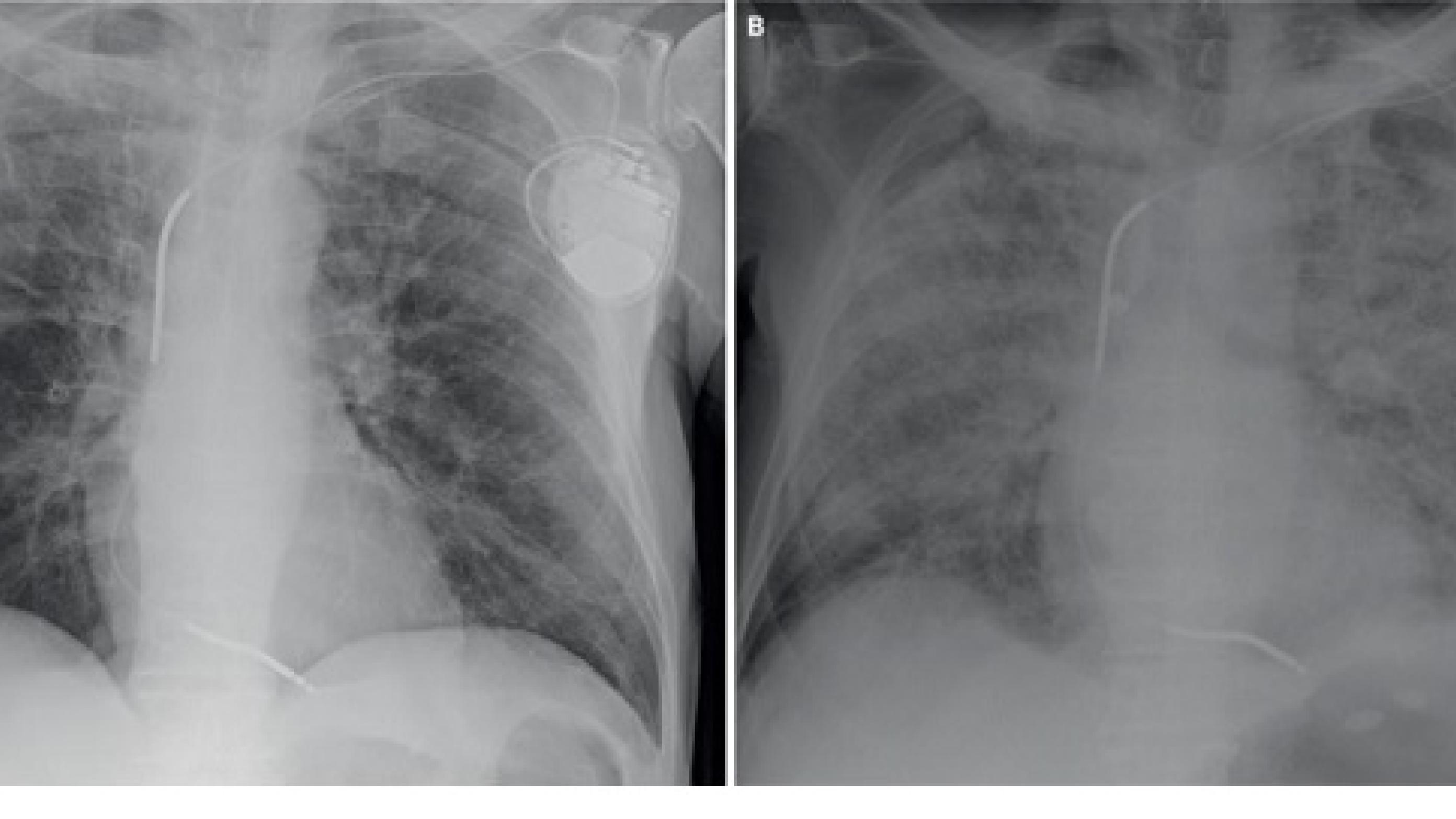 Røntgenbilleder af thorax af patienten i sygehistorie II.