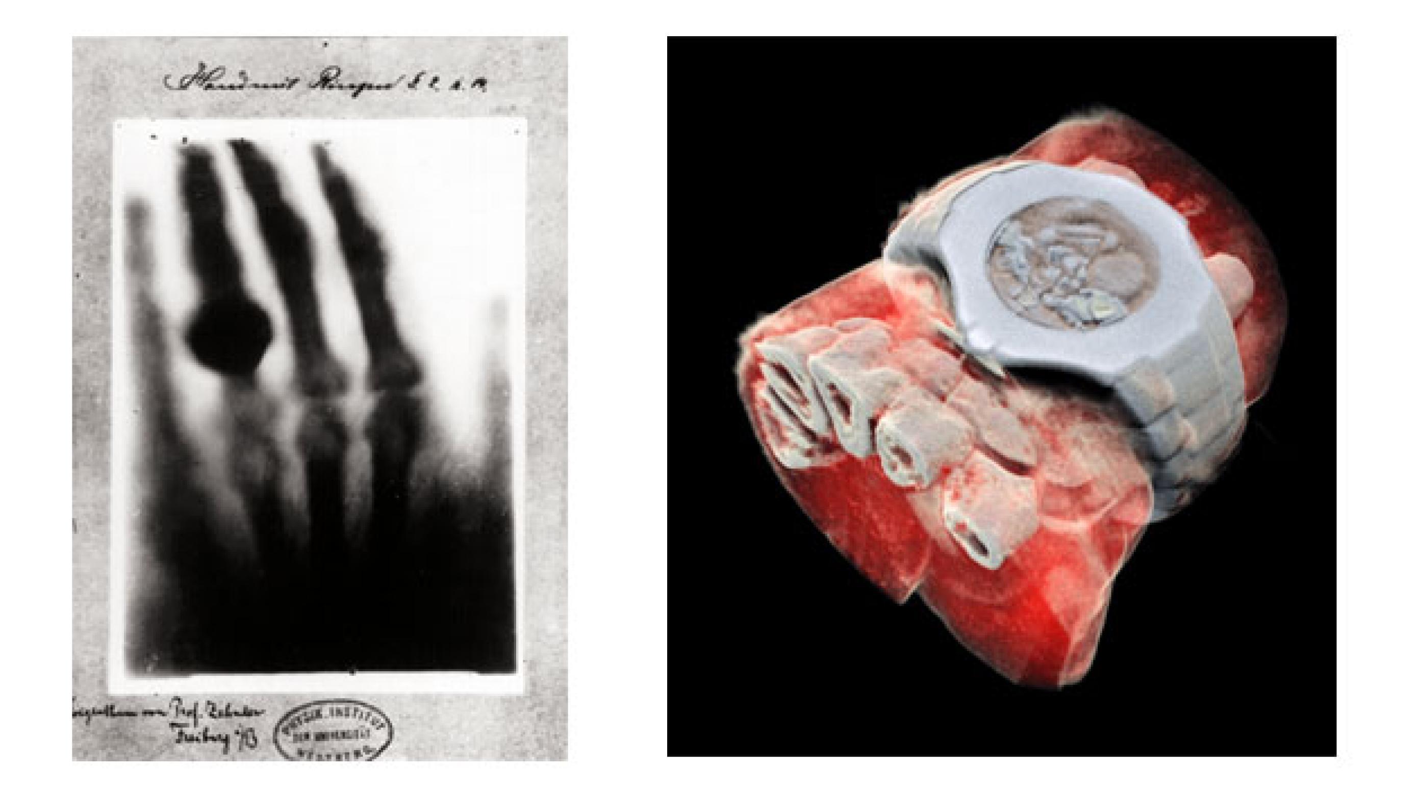 Verdens første røntgenbillede. W.C. Röntgens billede af sin kones hånd. Foto: Wikimedia Commons og 3D røntgenbillede i farver. Foto: Mars Bioimaging