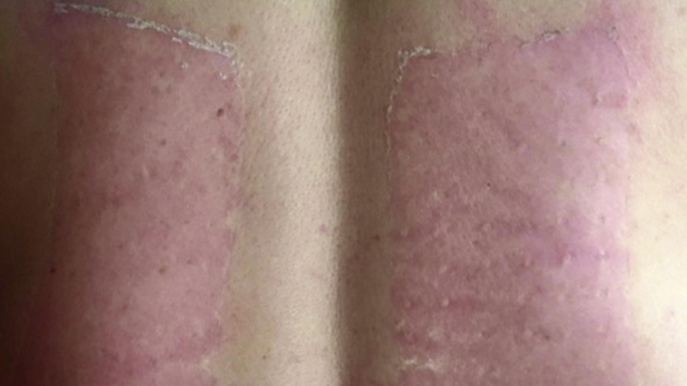 Rødme og ødem af huden efter fjernelse af chiliplastre. Billedet bringes med patientens tilladelse.