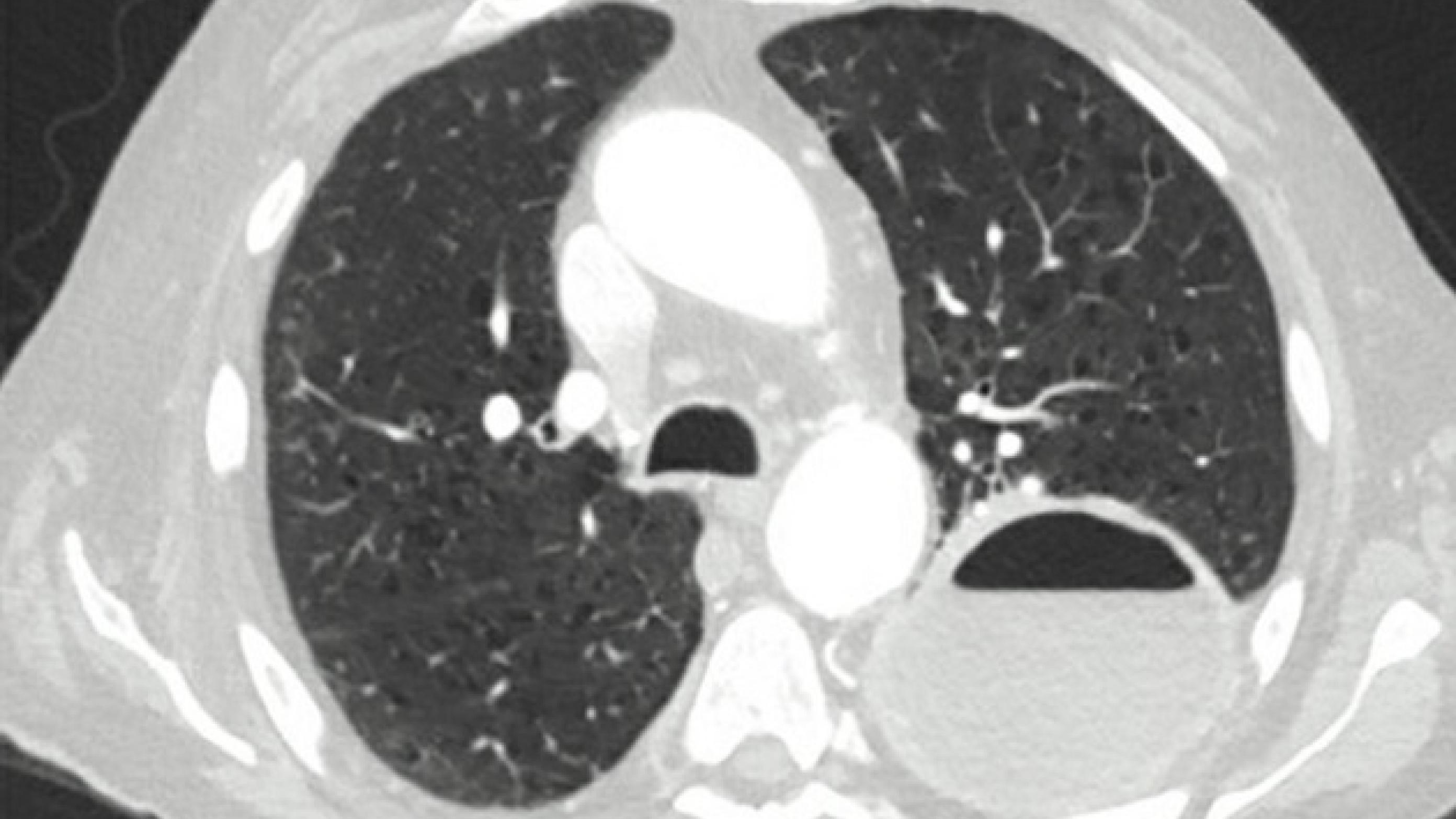 CT af brystkassen hos en patient med en stor absces i venstre lunge