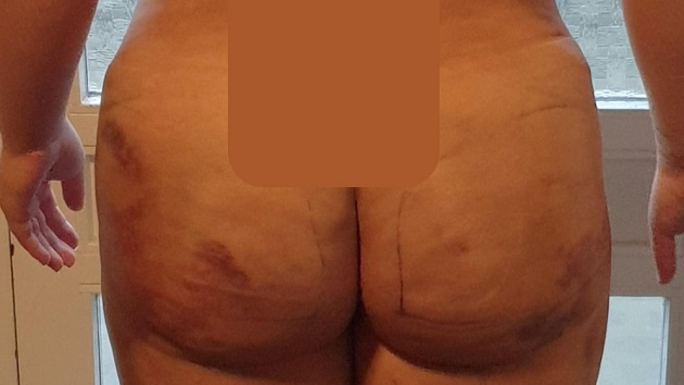 En 28-årig dansk kvinde blev indlagt med fedtembolisyndrom på et dansk sygehus efter athave fået foretaget en Brazilian butt lift-operation i Tyrkiet, hvor man havde fedtsuget 8,5 lfedt fra hhv. mave, ryg, inderlår og overarme og efterfølgende injiceret 2 l fedt i hver balle.(Billedet bringes med tilladelse fra patienten)