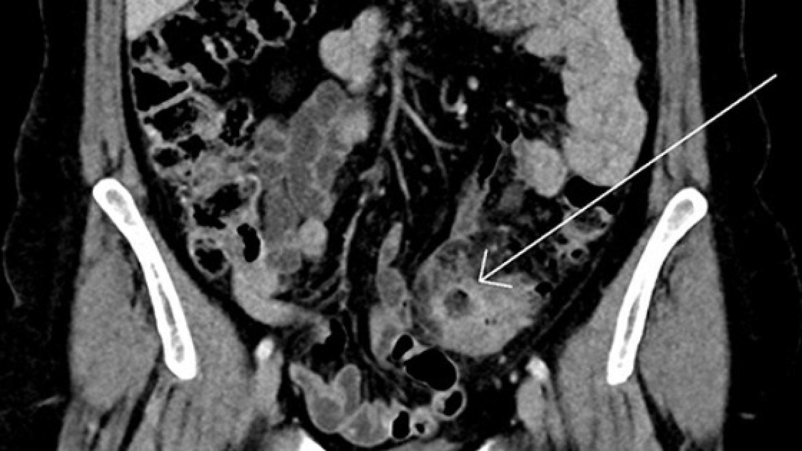 CT-billede af ukompliceret divertikulitis i colon sigmoideum med lokal inflammation og stranding omkring et divertikel (pil).