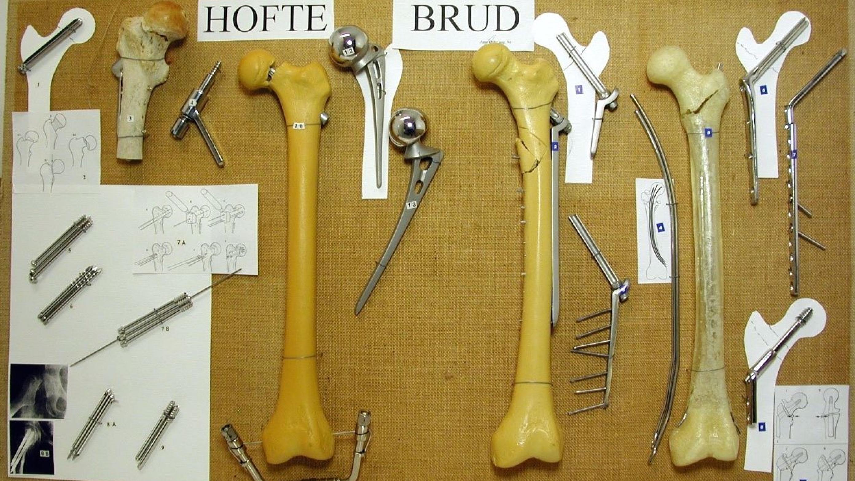 Denne undervisningstavle med hofteledsproteser indgår i samlingen fra Holstebro Sygehus. Foto: Medicinsk Museion.