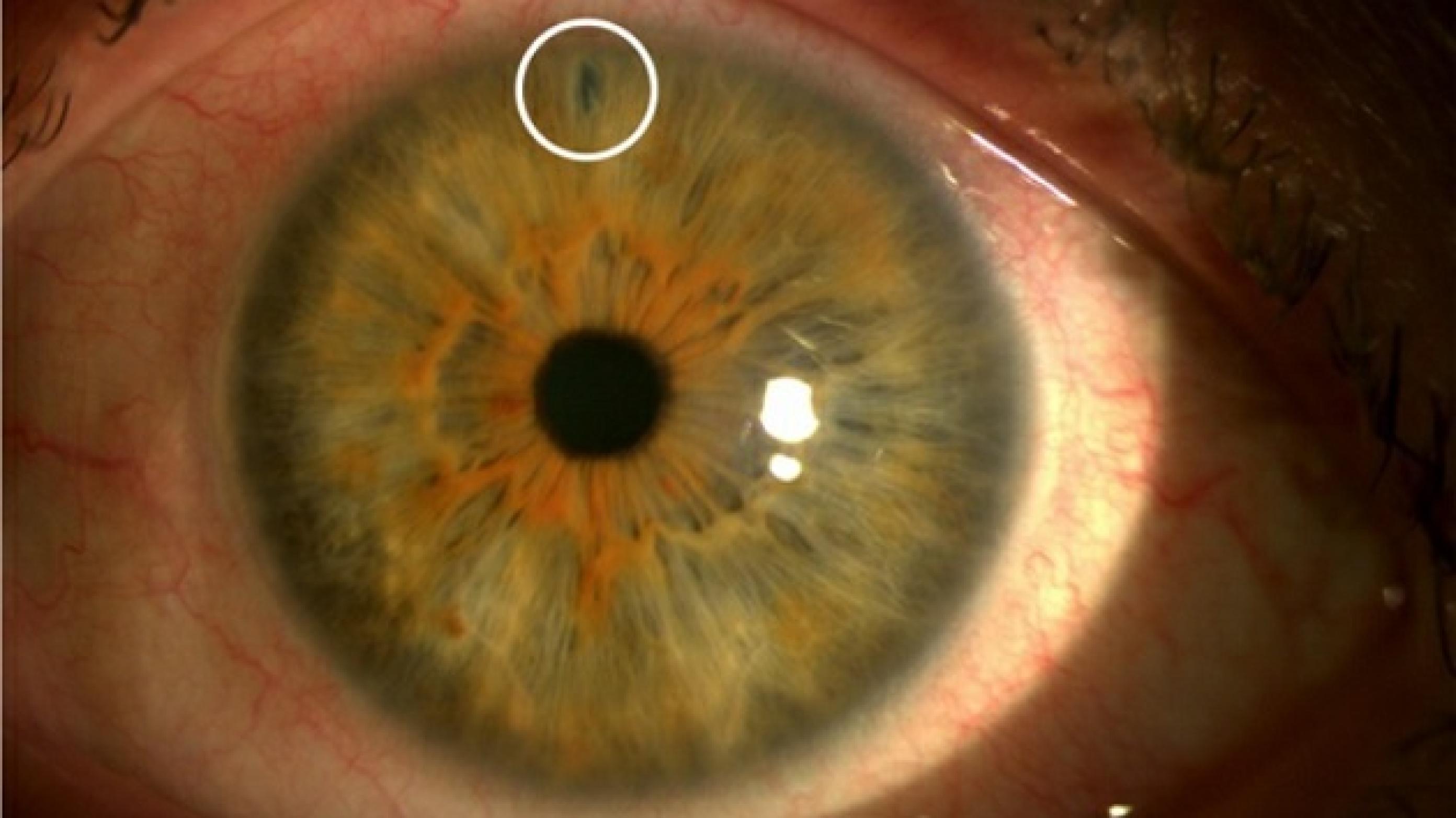 Foto af iridotomi. Iridotomi er et cirka 200 µm hul i iris. Hullet laves med laser, hvorved en eventuel trykdifference over iris elimineres.