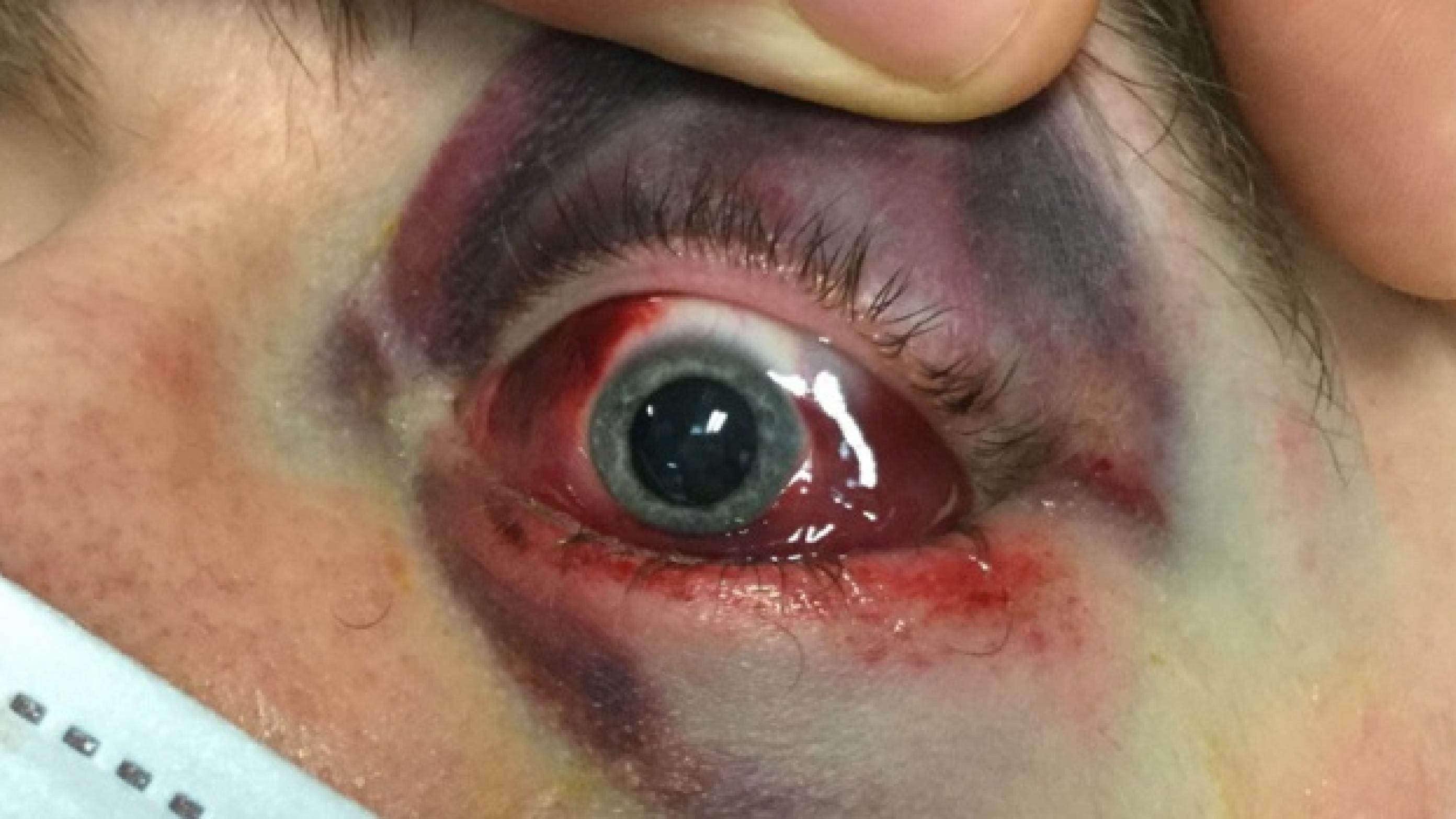 Venstre øje med periokulært ødem og misfarvning, subkonjunktivalt hæmatom, pupildilatation (efter indgift af tropicamidøjendråber) og exophthalmus. 