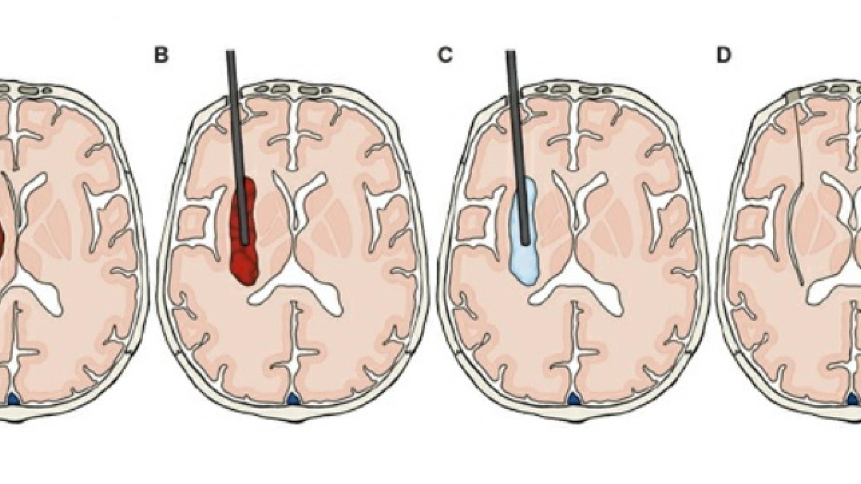 Stillistisk illustration af et supratentorielt intracerebralt hæmatom beliggende i insula (Ugeskr Læger 2021;183:V01210083)