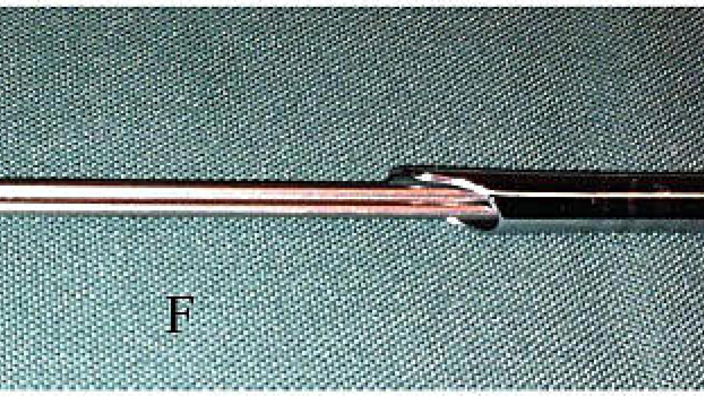An optical forceps (F) is passed through the rigid bronchoscope (B) to firmly grab a piece of almond (A). The forceps and the rigid bronchoscope can then be removed simultaneously from the respiratory tract whereby the foreign body is removed.