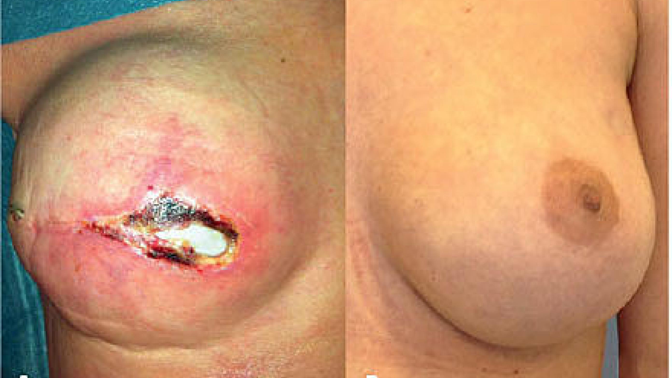 Post-operative results: A. Skin flap necrosis in a smoker revealing the acellular dermal matrix underneath. B. Nipple-sparing breast reconstruction in a non-smoker.