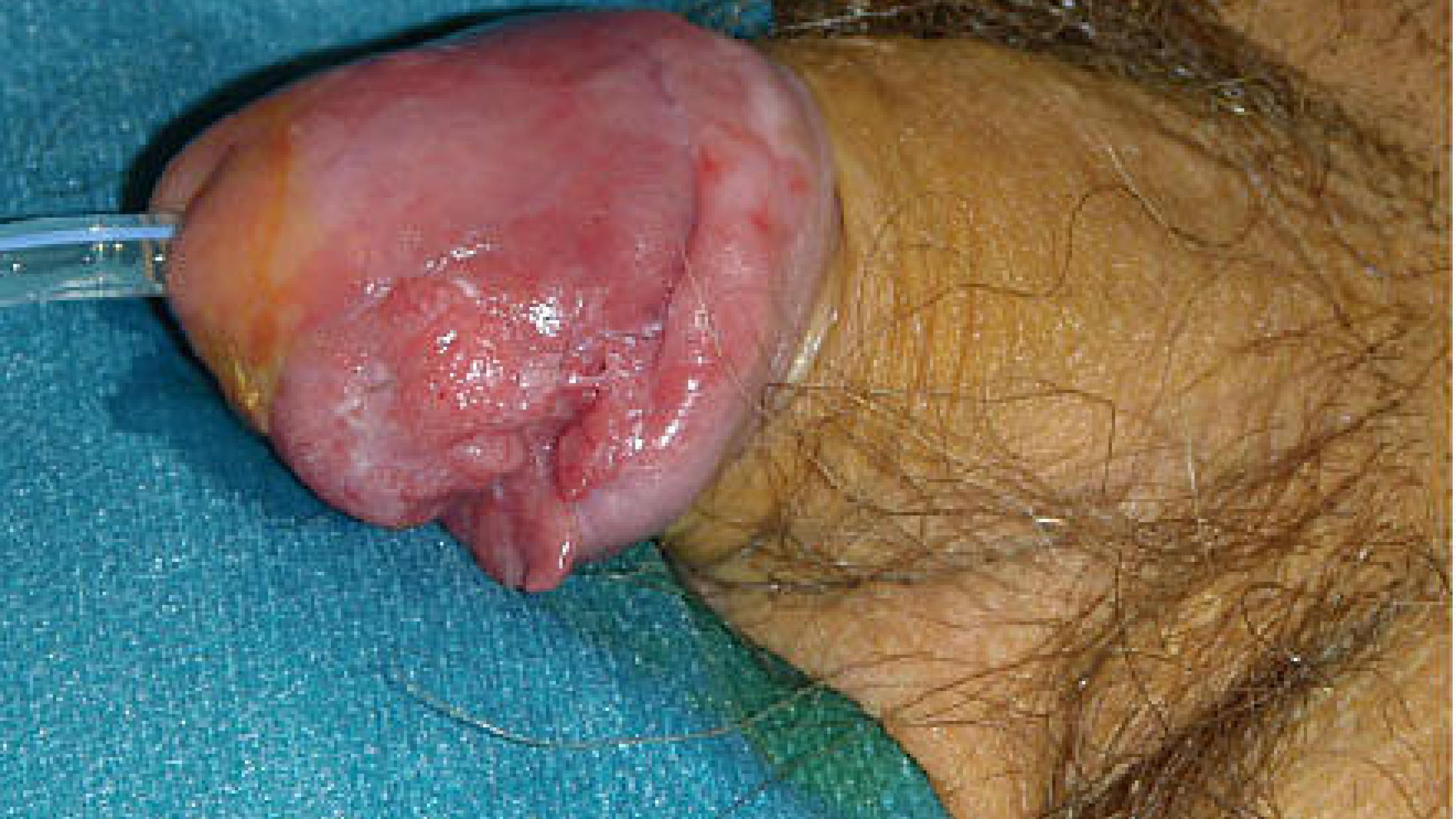 Penile tumour on the left side of the glans involving the corona glandis. Histopathological tumour growth into corpus spongiosum without urethral involvement (T2).
