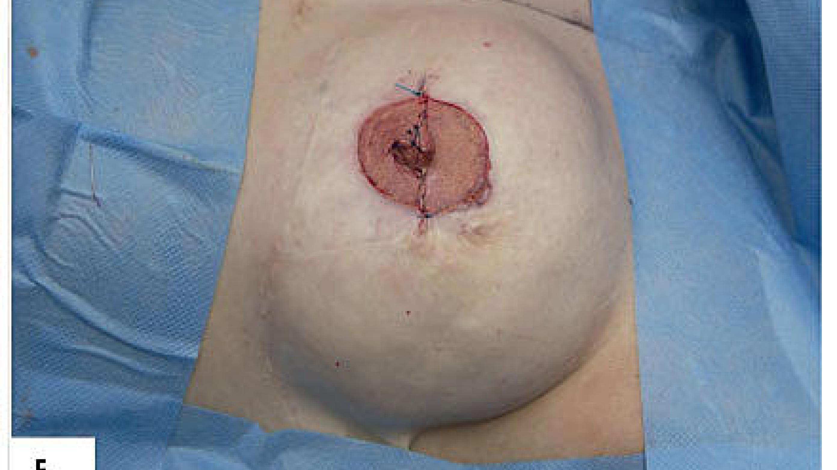 The nipple is reconstructed and the donor defect is closed.