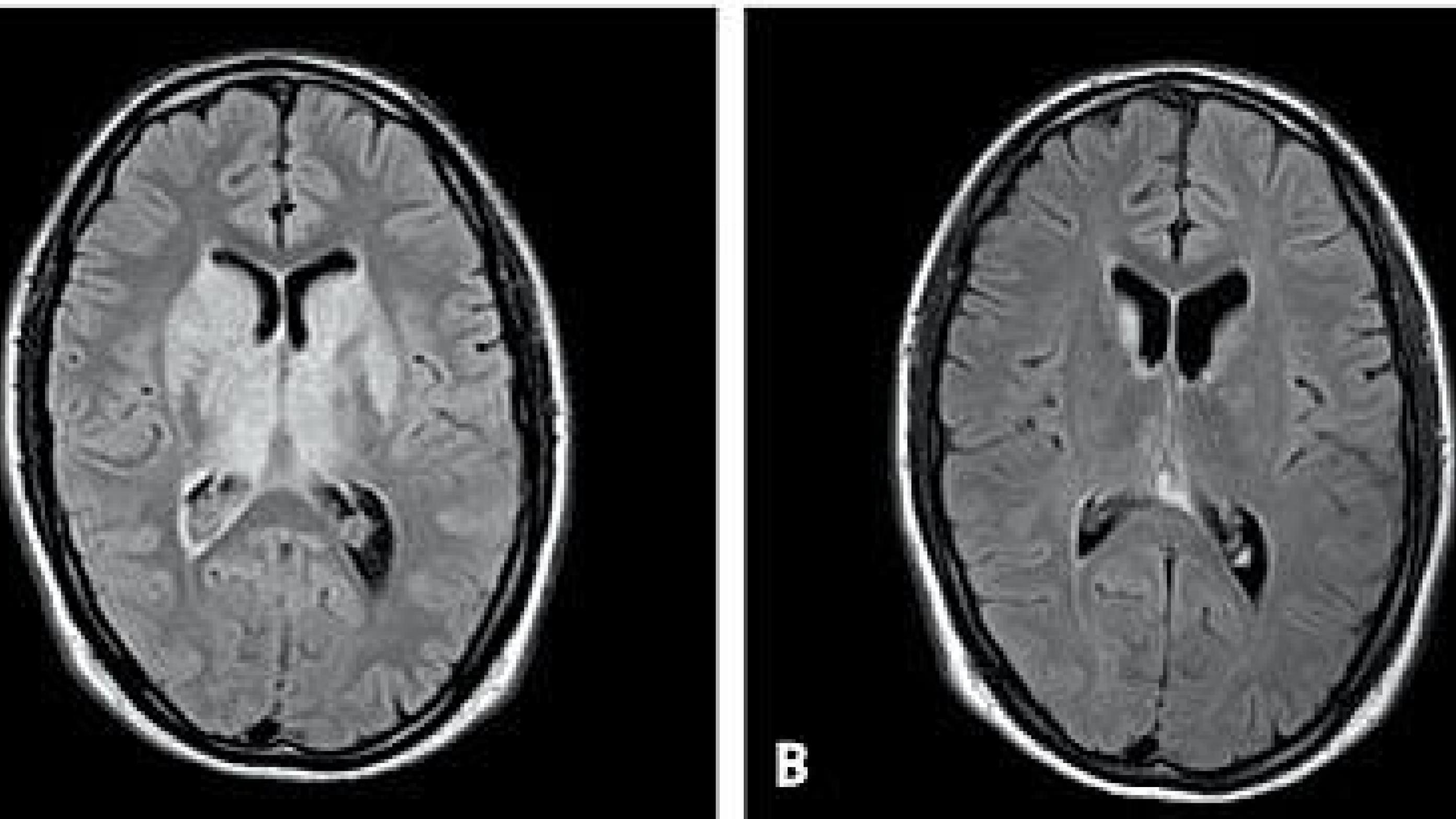 Magnetic resonance imaging flair illustrating central oedema in patient ID 2 prior to endovascular treatment (A) and after 72 h of thrombolysis (B). Note the diminished central cerebral oedema after recanalization.