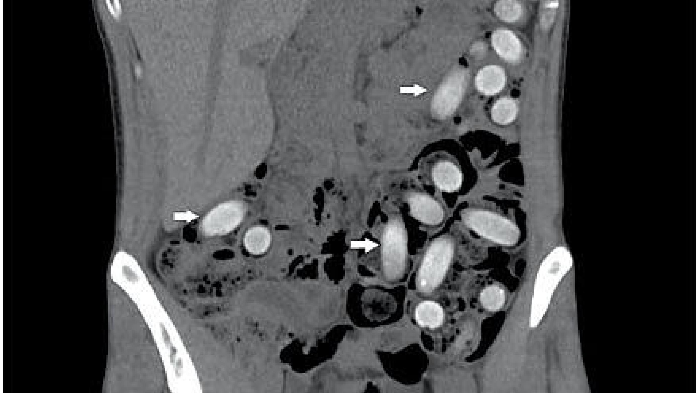 A CT showing multiple intra-abdominal foreign bodies (arrows) in a male body packer.