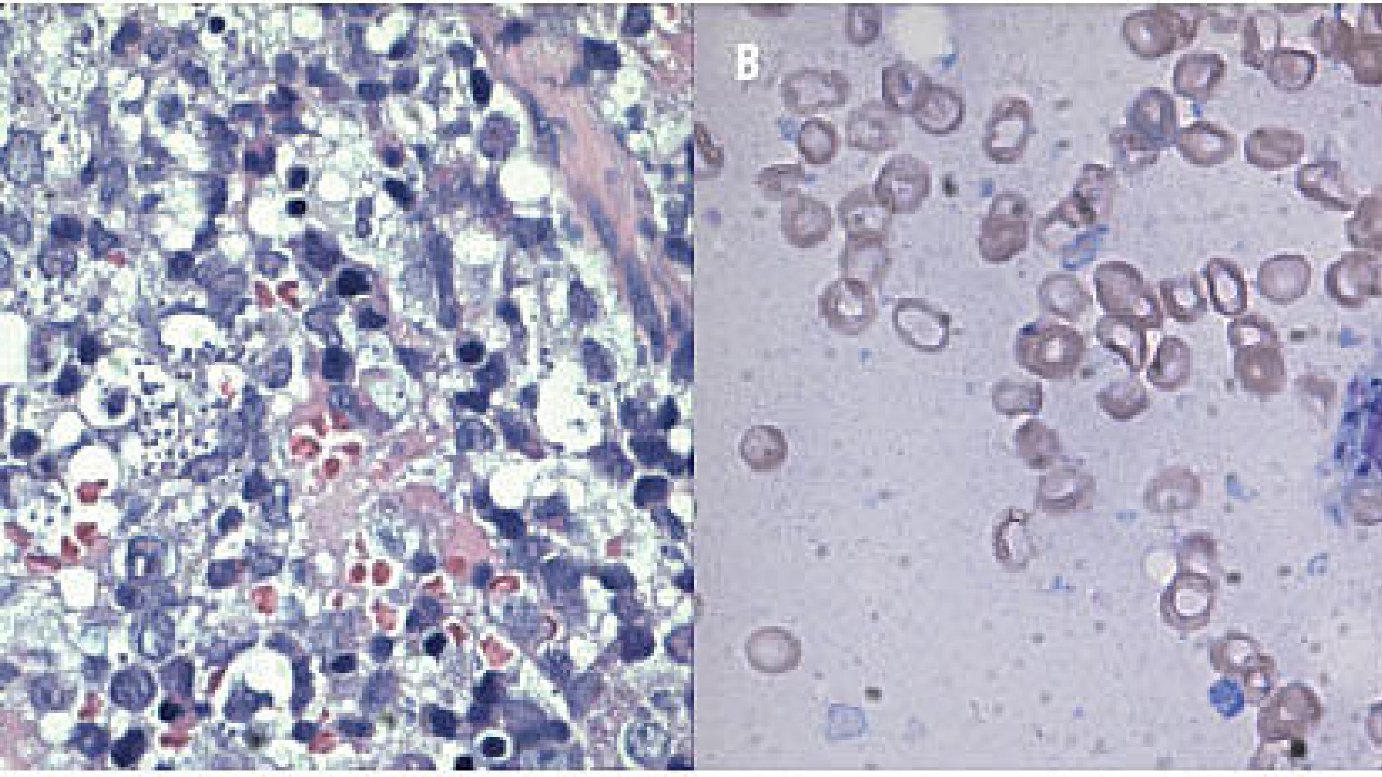 A. Broget marv med talrige makrofager indeholdende amastigoter. B. Makrofag med mange amastigoter. (Fra sygehistorie I).