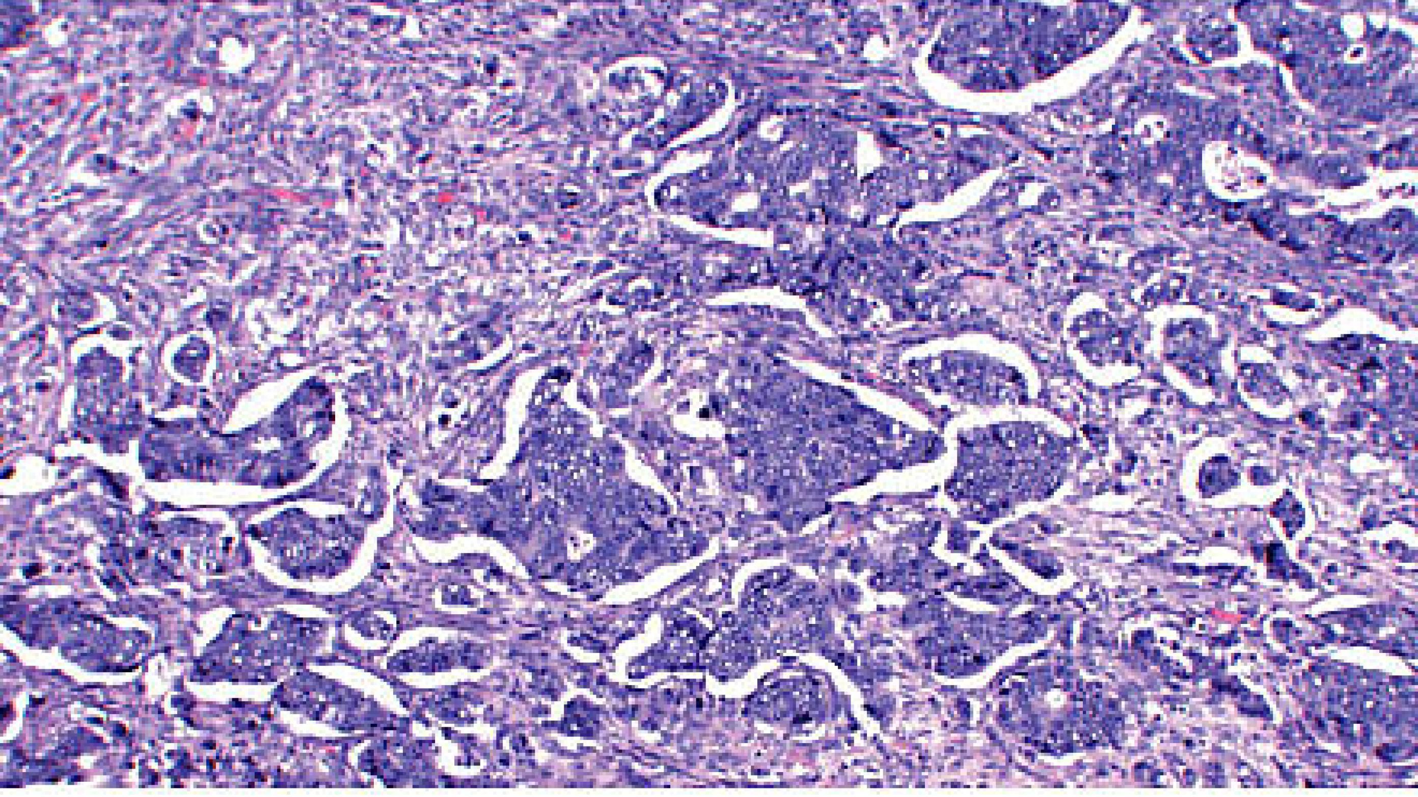 Haematoxylin and eosin-stained section of a colorectal adenocarcinoma.