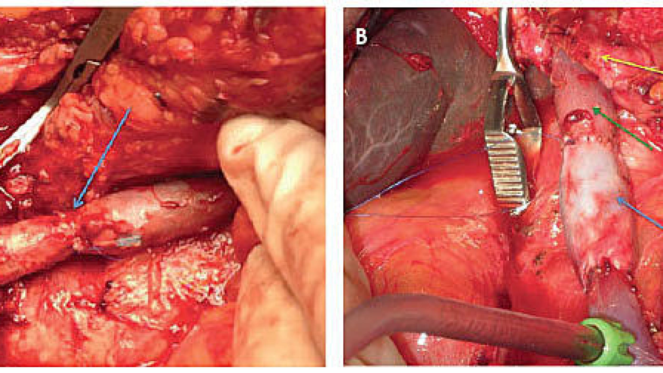 A. Portal vein/superior mesenteric vein resection with direct end-to-end anastomosis at site of resected portal vein/superior mesenteric vein.