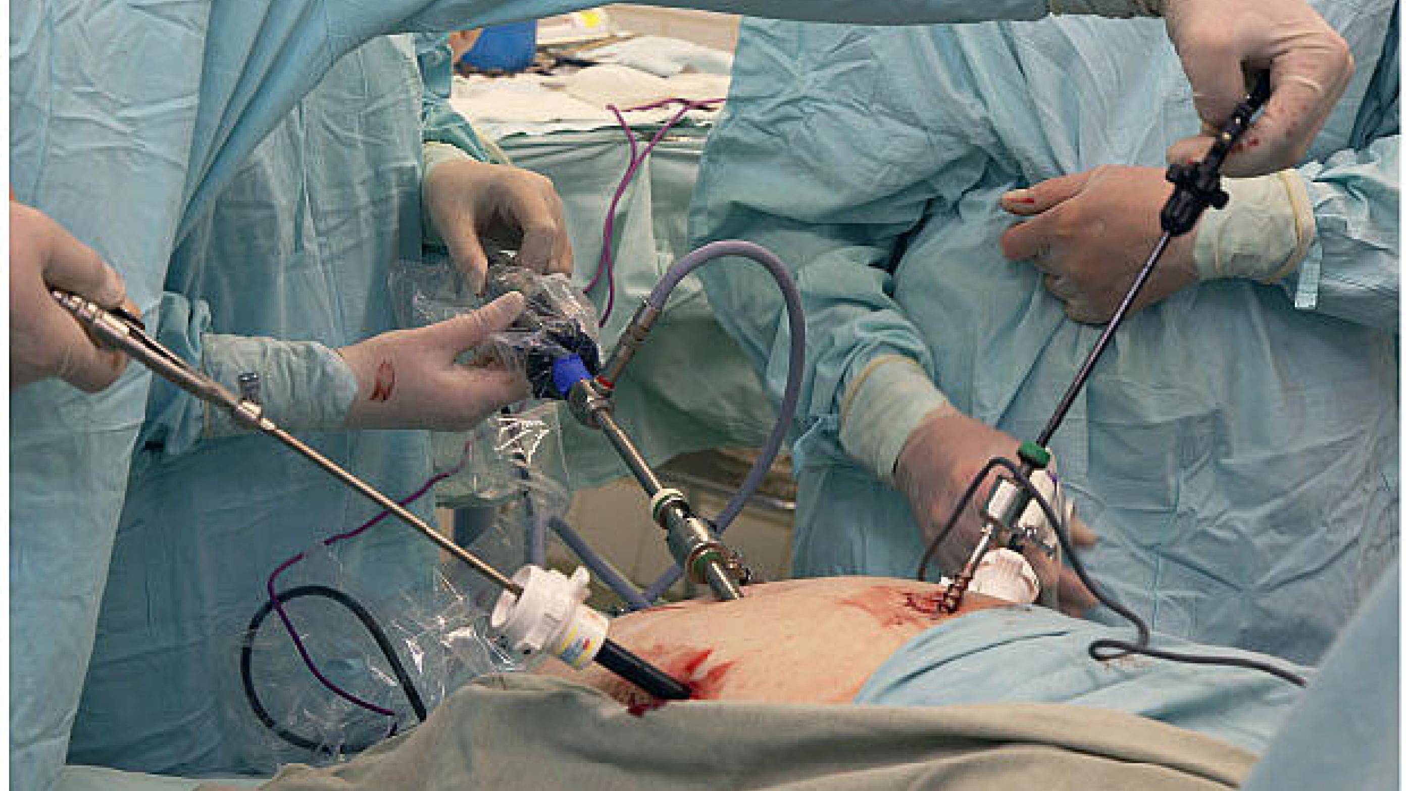 Operationsopstilling ved laparoskopisk ­kirurgi.