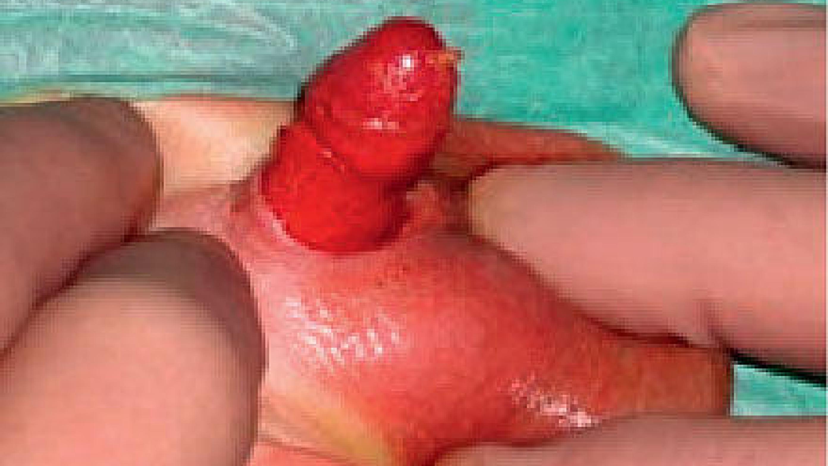Complete excision of all penile skin as a complication to newborn male circumcision.