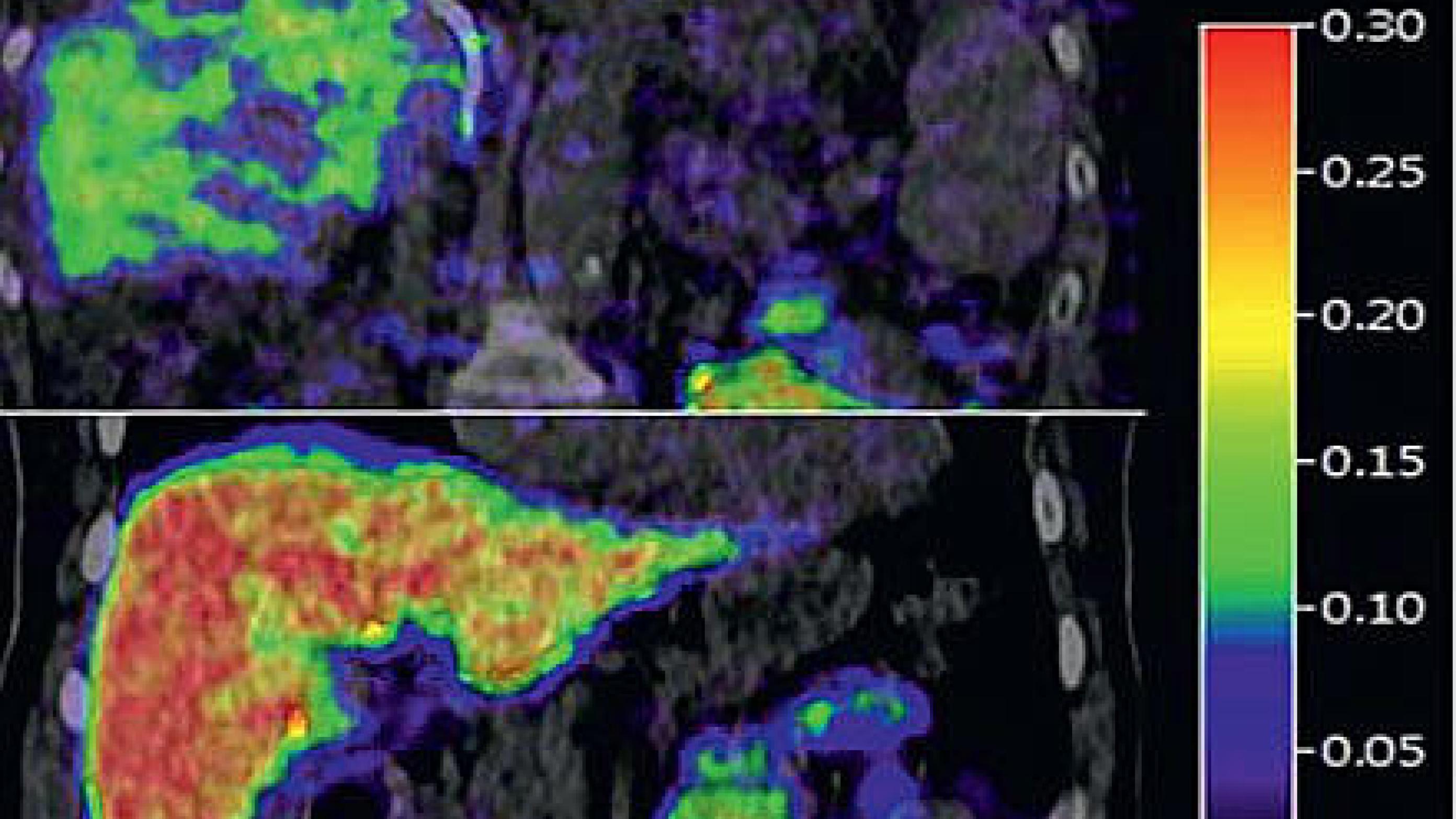 Galaktose-PET/CT af en lever med cirrose (øverst) og en normal lever (nederst).