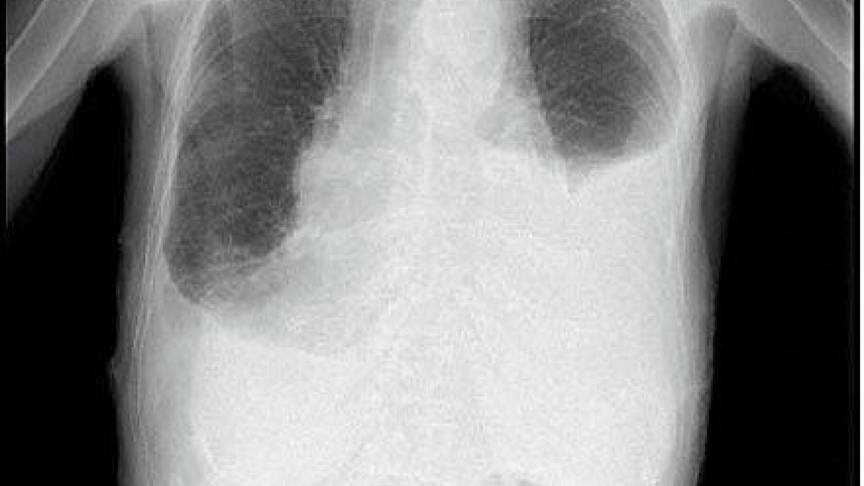 Røntgenbillede af thorax med udtalt højresidig pleuraekssudat.