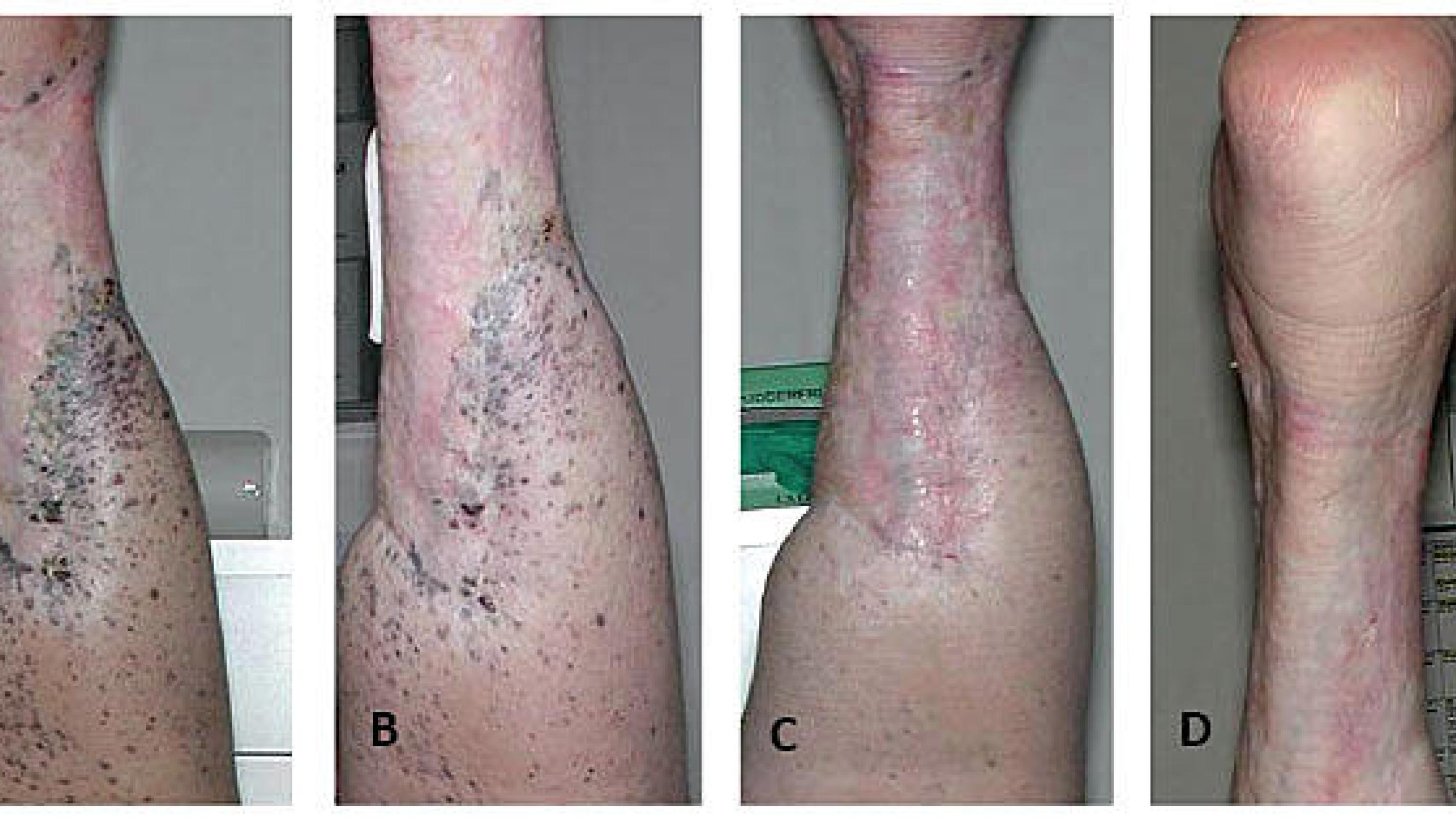 Two and a half years after isolated limb perfusion (ILP), no metastases were visible in the perfused limb.