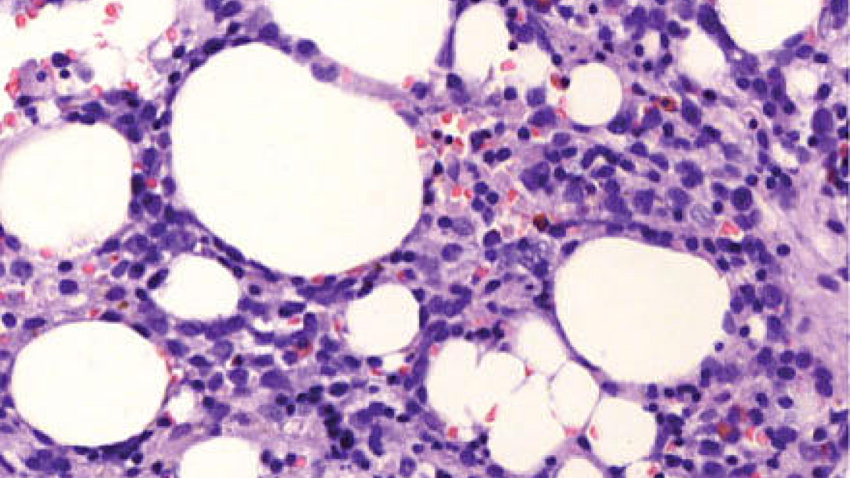 Histologisk undersøgelse af knoglemarven viste beskeden opmodning af myelopoiesen og ca. 20% differentieringskompleks (CD)34-, CD117- og myeloperoxidasepositive blastceller. Hæmatoxylin-eosin-farvet snit fra cristabiopsien, × 20.