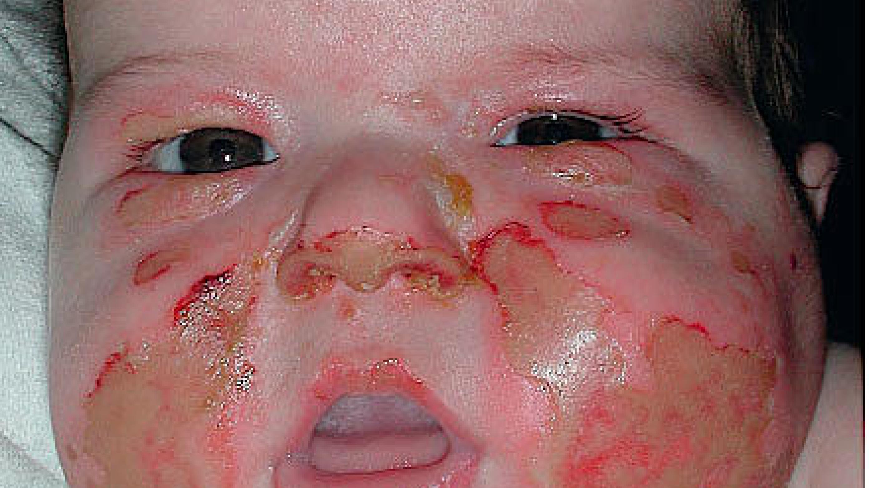 Et tre måneder gammelt barn med ansigtsforbrænding.