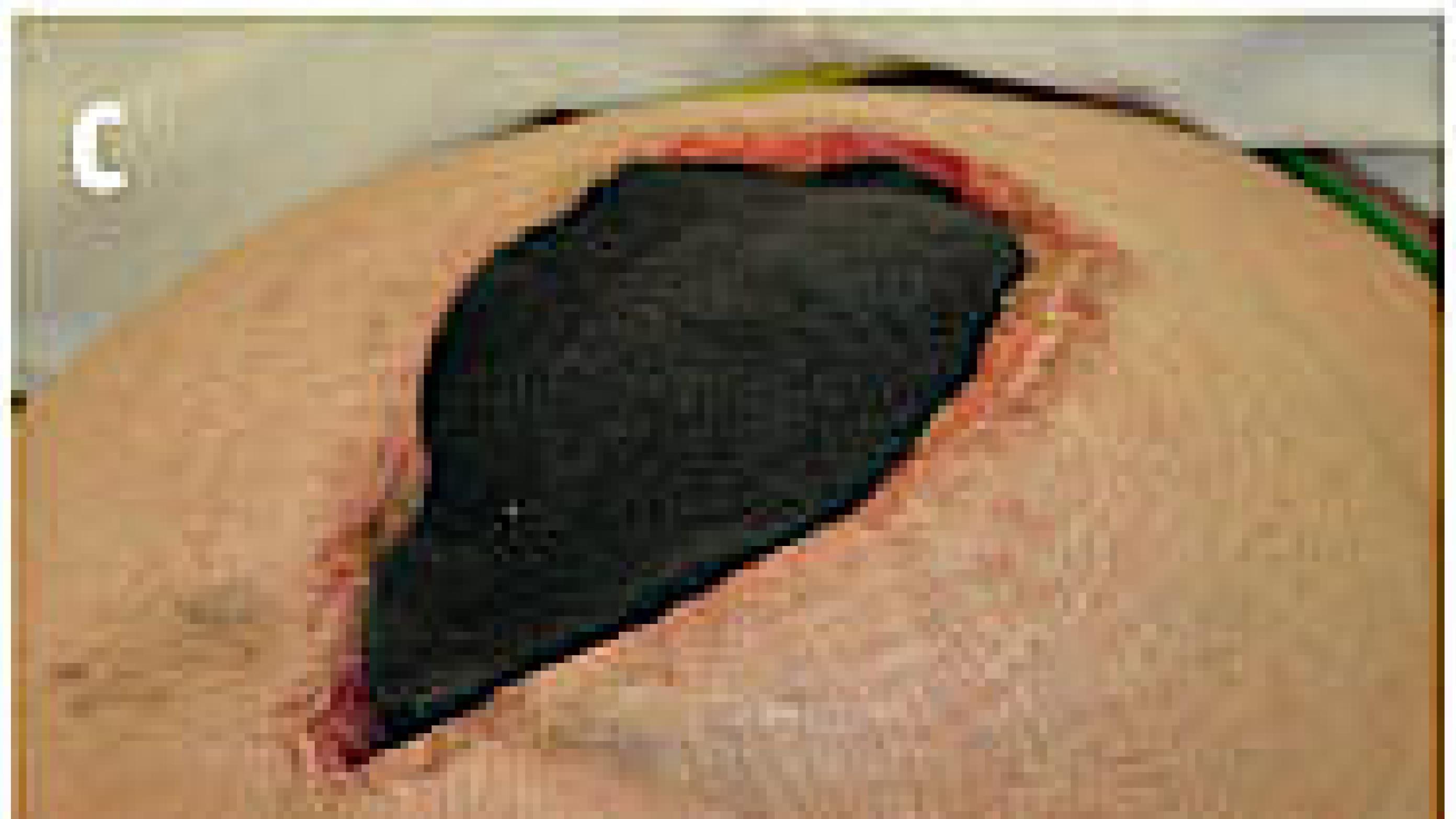 Photographs of layers in vacuum-assisted wound closure and mesh-mediated fascial traction.