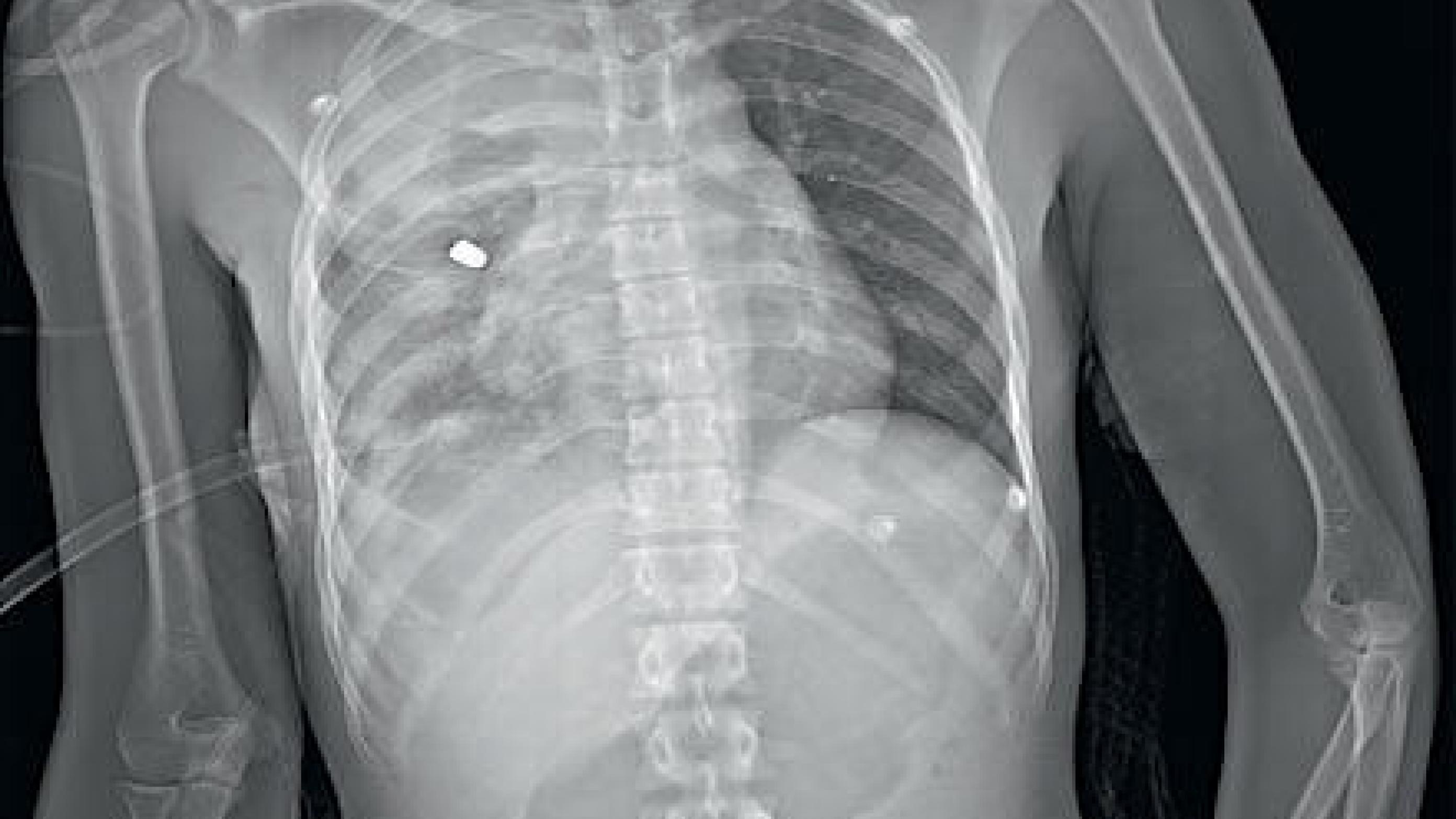 Røntgenbillede af en traumepatient med projektiler siddende i højre thorax og lår.
