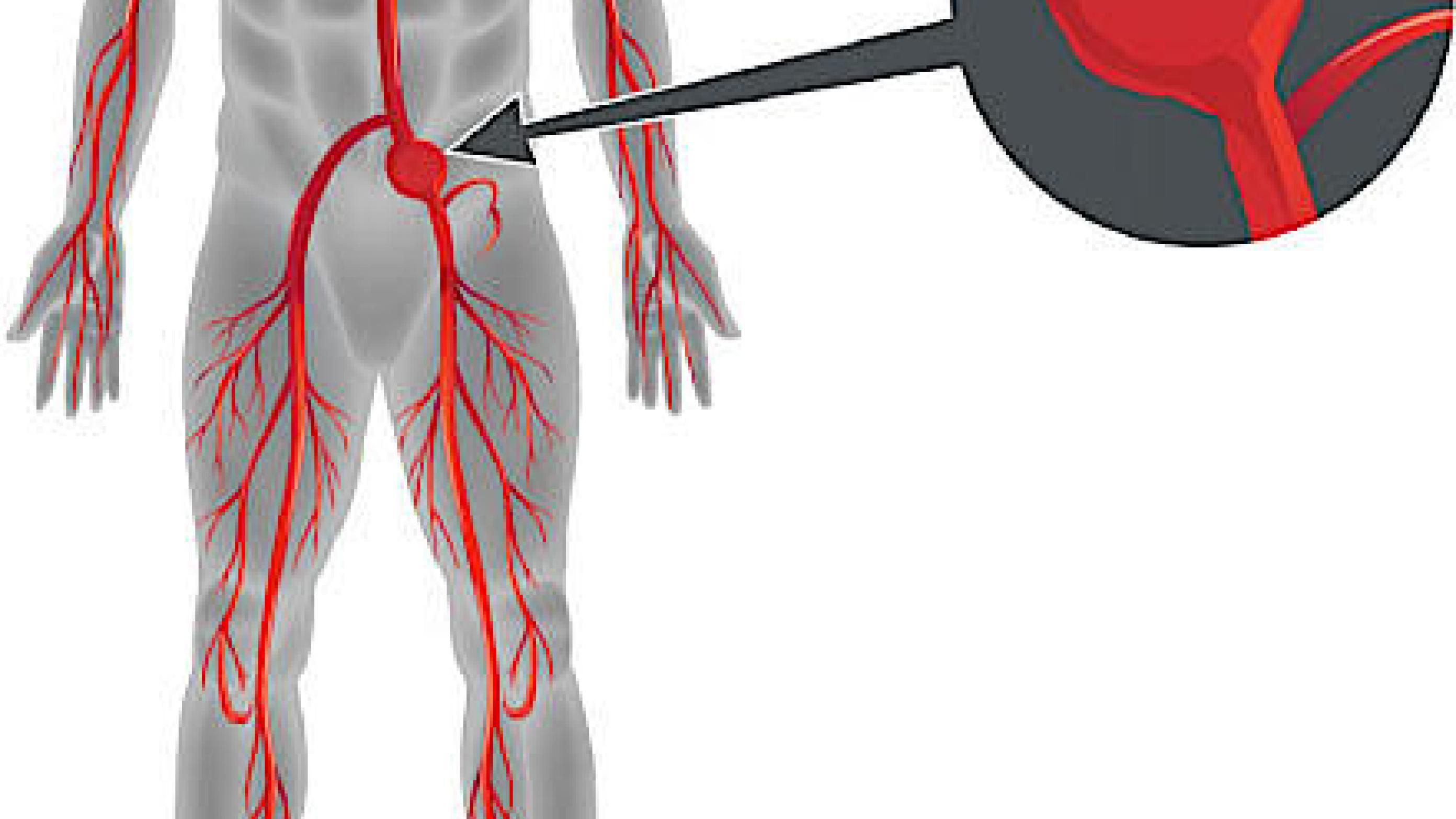 Illustration af aneurisme på arteria iliaca communis.