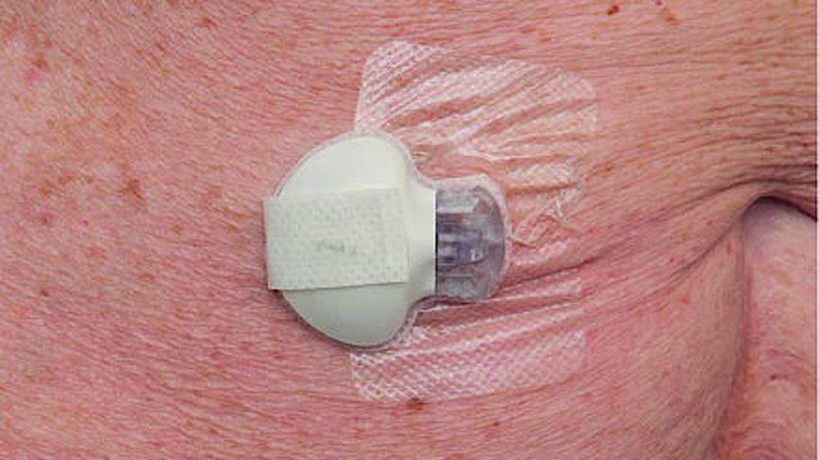 Kontinuerlig glukose­måler på maven på en tidligere Roux- en-Y-­gastrisk bypass-opereret person. Foto: Pia Krone Madsen.