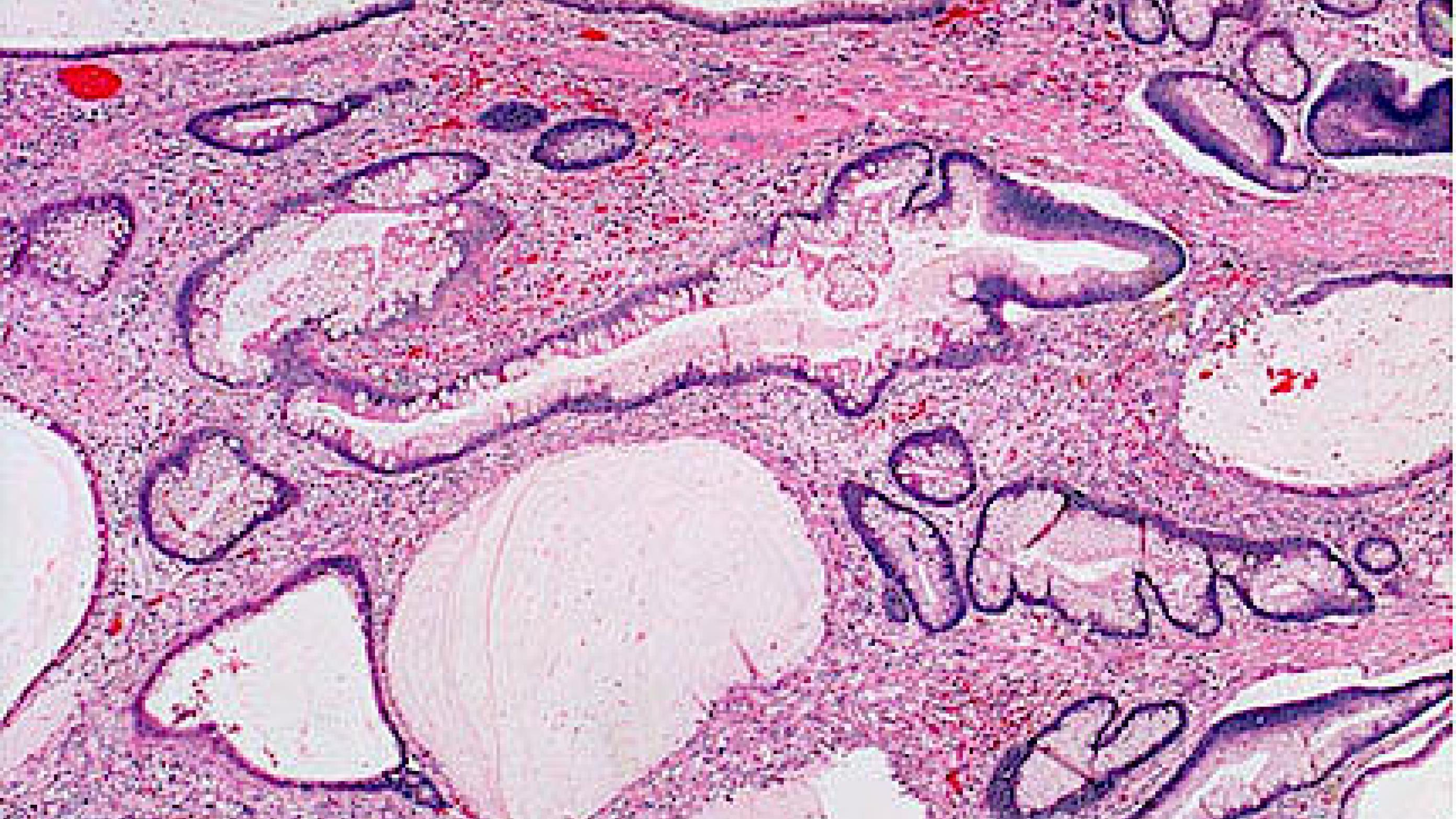 Mikroskopisk billede af juvenil polyp. Ved juvenile polypper ser man cystisk dilaterede kirtler, oftest mucusfyldte, med kubisk til cylindrisk epitel samt ødematøst og inflammeret stroma.