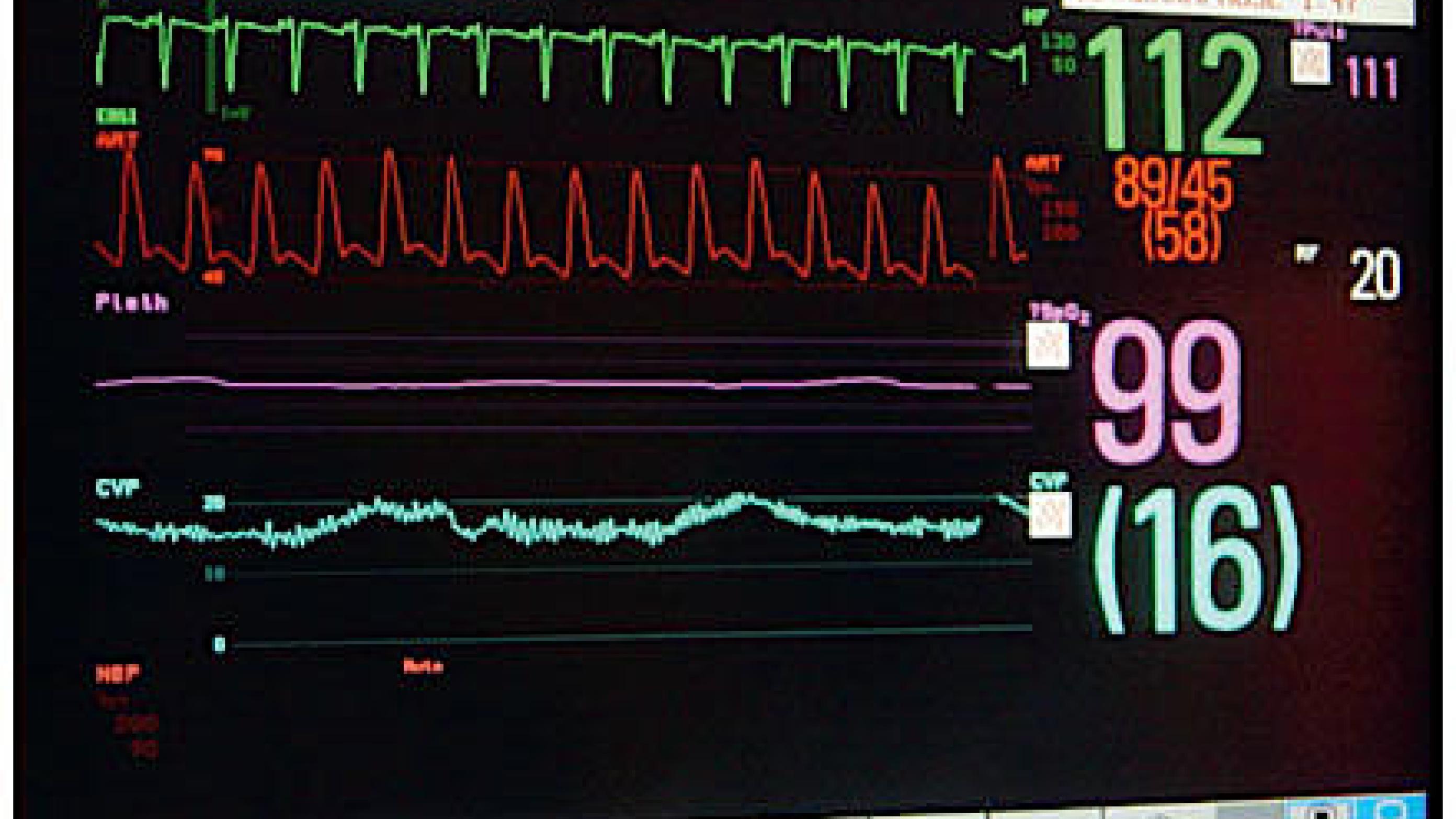 Haemodynamic monitoring of an intensive care unit patient.