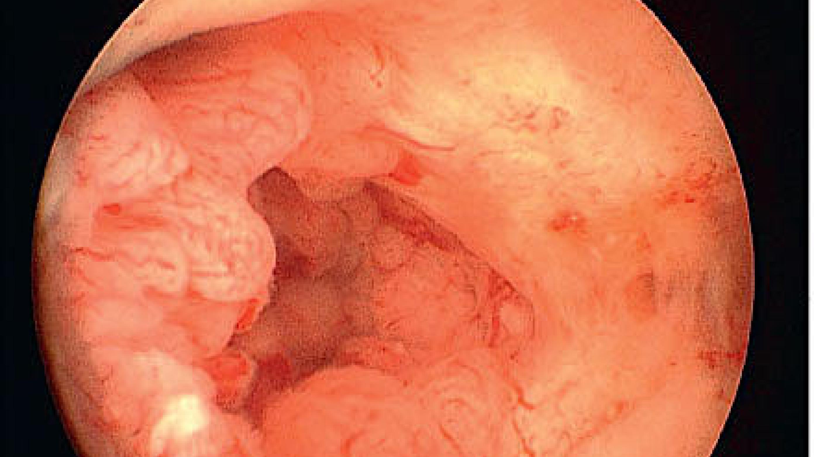 Endometrial cancer seen by hysteroscopy.