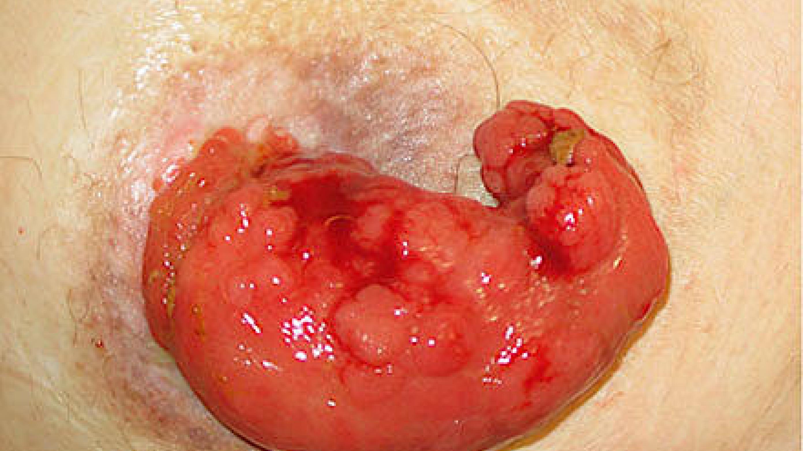 Et adenokarcinom på en ileostomi.
