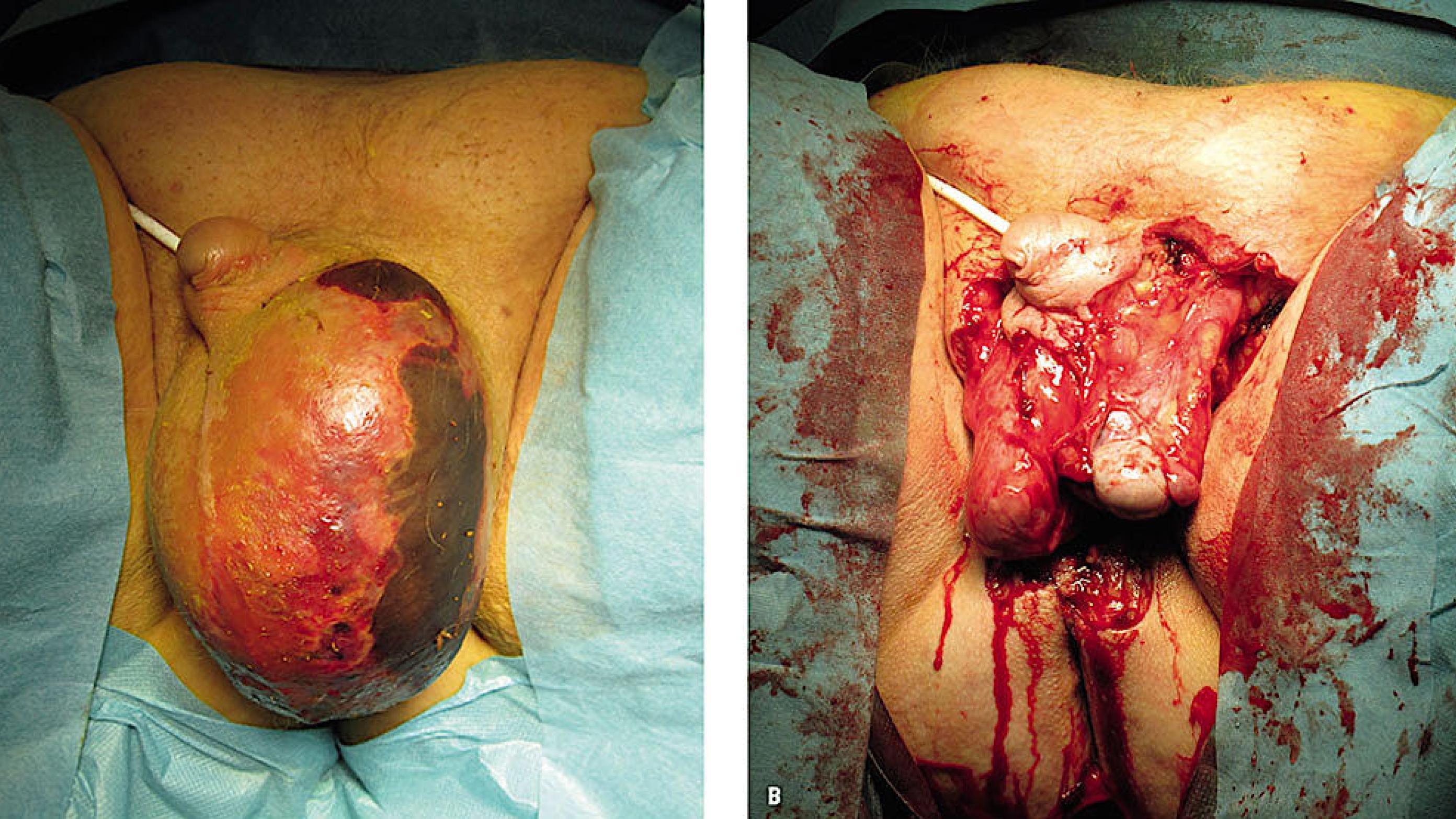 A. Hævelse og misfarvning af venstre skrotalhalvdel. B. Begge testiklerne ligger blottede efter resektion.
