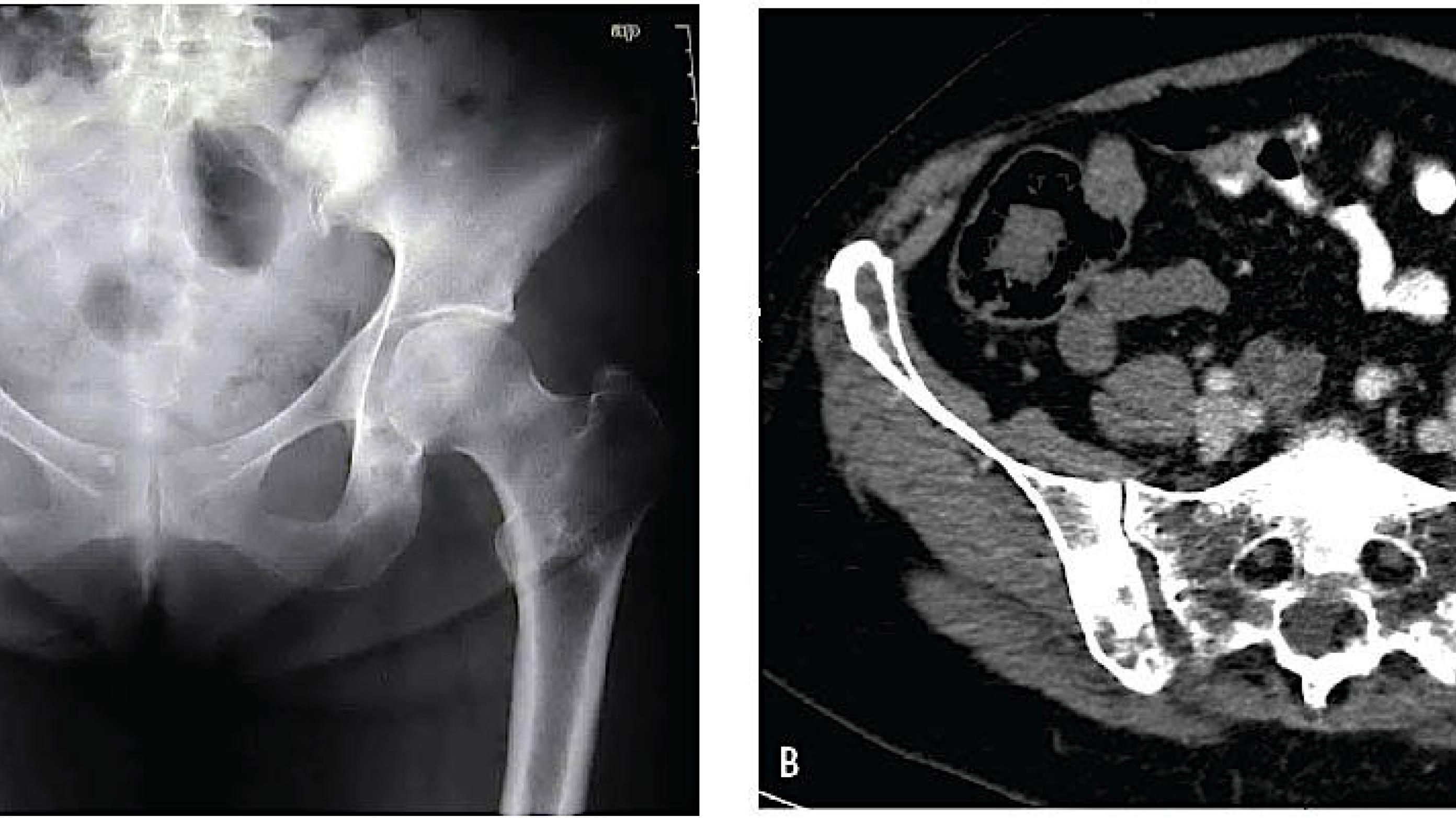 A. Multiple knoglemetastaser i pelvis og højre femur hos en patient med brystkræft. B. CT. Der ses komplicerende knoglemetastaser i os sacrum og pelvis hos en patient med brystkræft.
