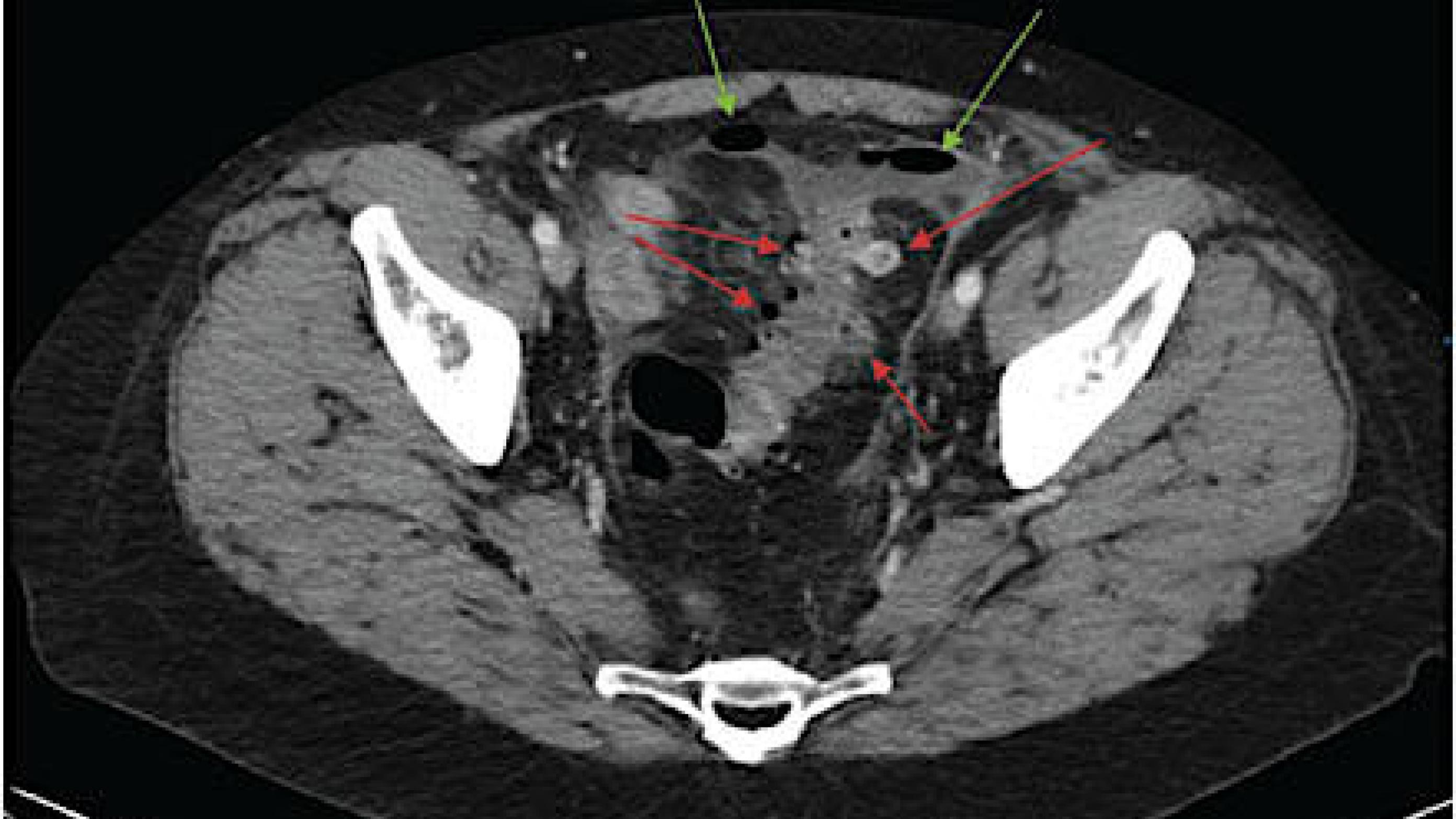 CT af perforeret divertikulitis med colondivertikler (røde pile) og fri luft i abdomen (grønne pile).