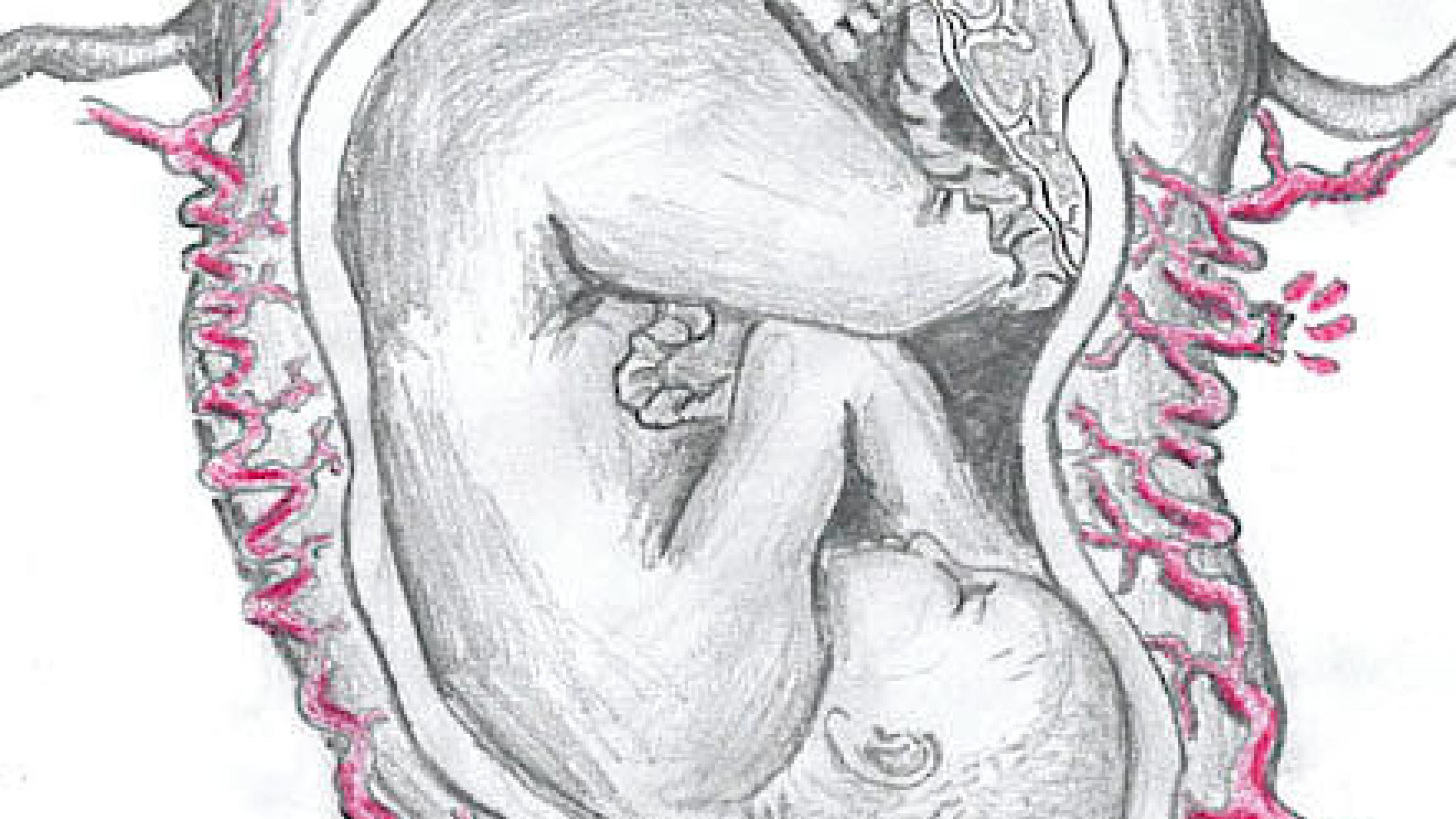 Spontan ruptur af a. uterina i gravid uterus.