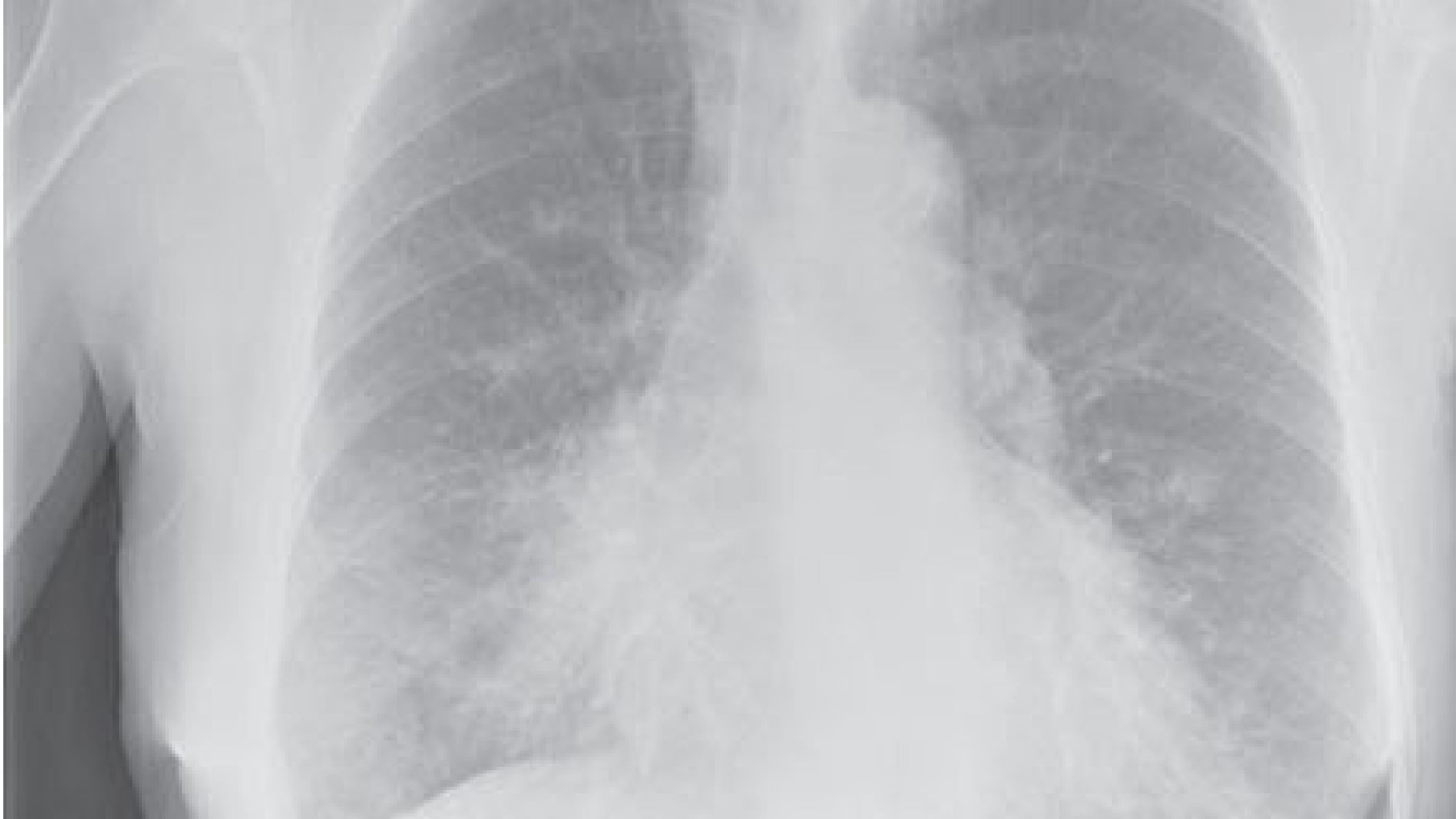 Mellemlapspneumoni hos en patient med kronisk obstruktiv lungesygdom.
