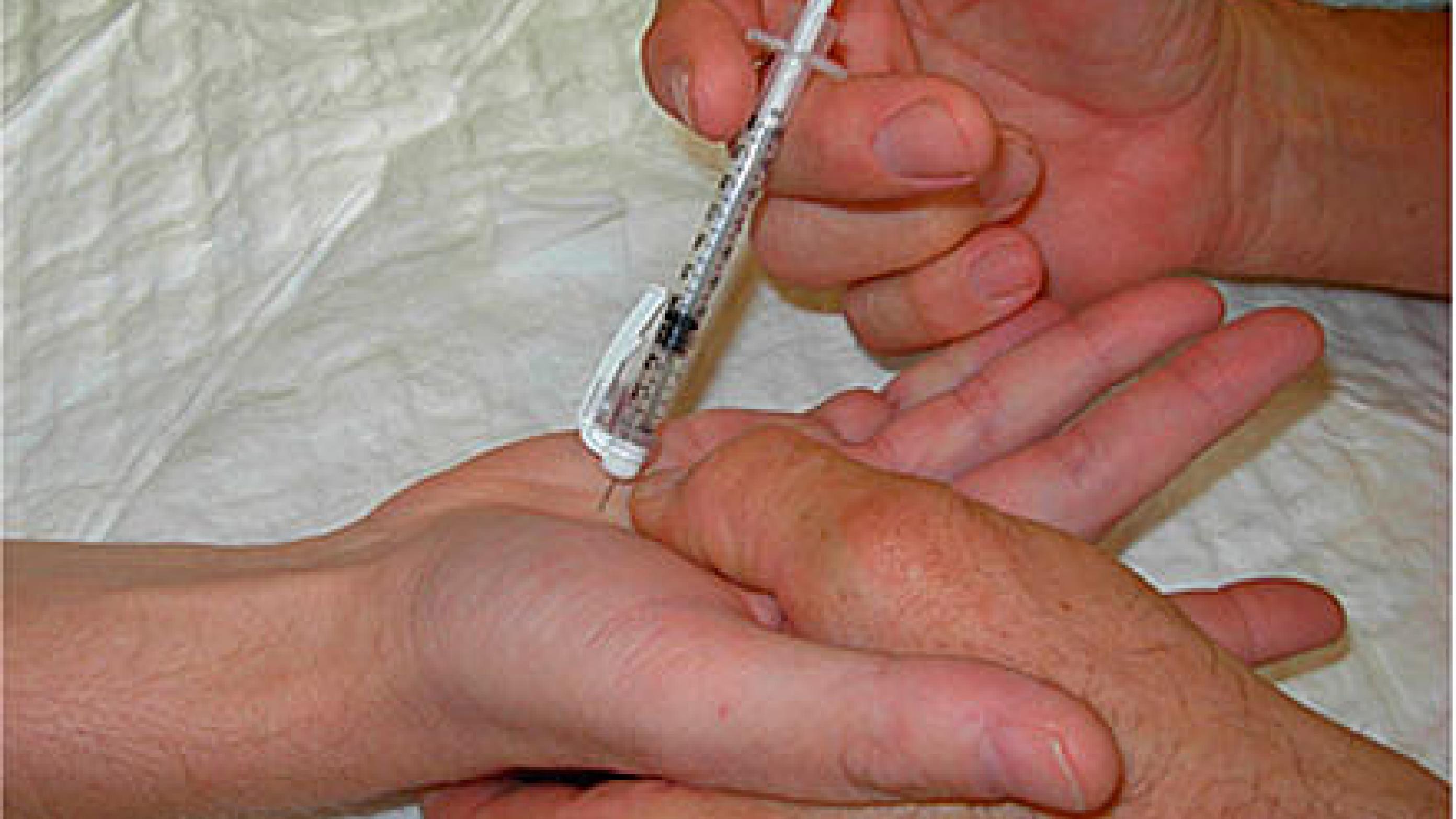 Injektion af kollagenase til behandling af Dupuytrens kontraktur.