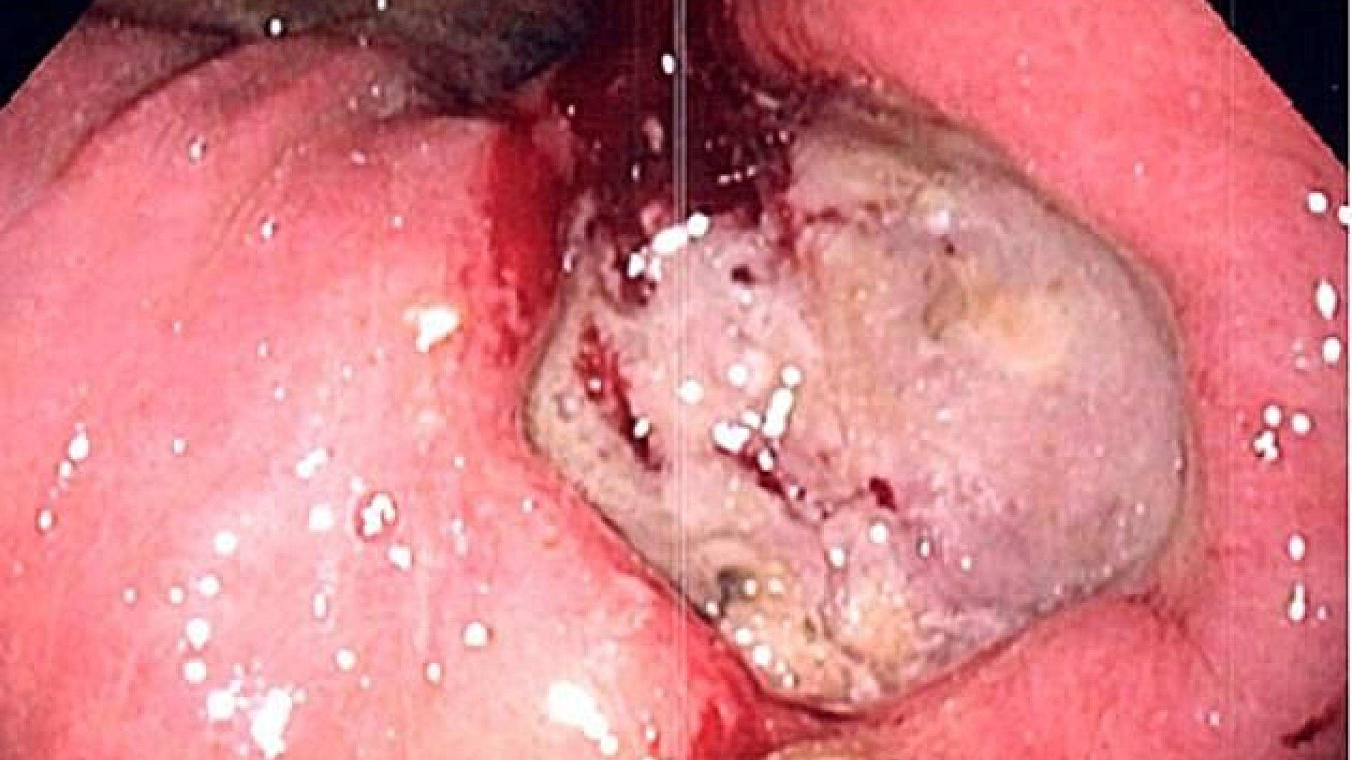 Fibrinbelagt ulcus ventriculi med randblødning.