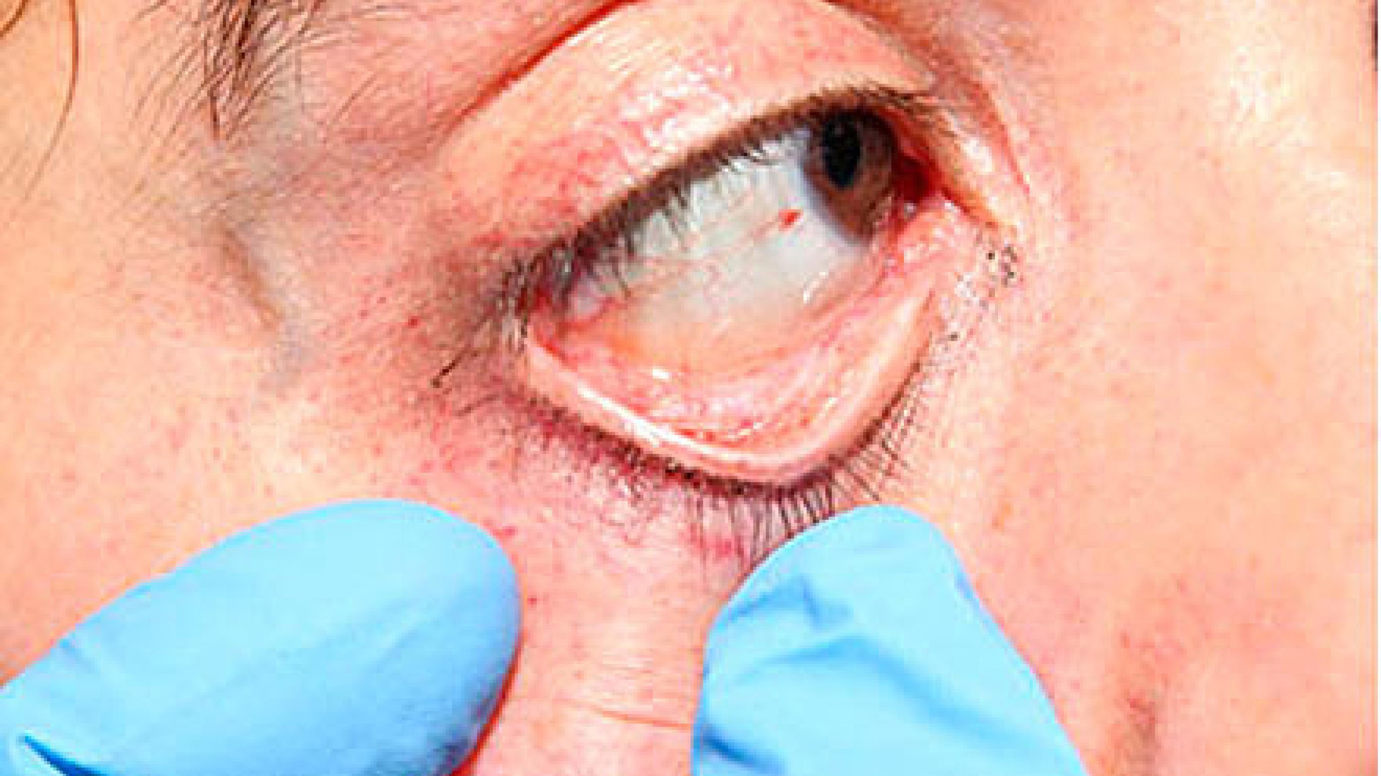 Punktformede blødninger i øjnenes bindehinder og øjenomgivelserne er tegn på et kraftigt og dermed livsfarligt halsgreb.