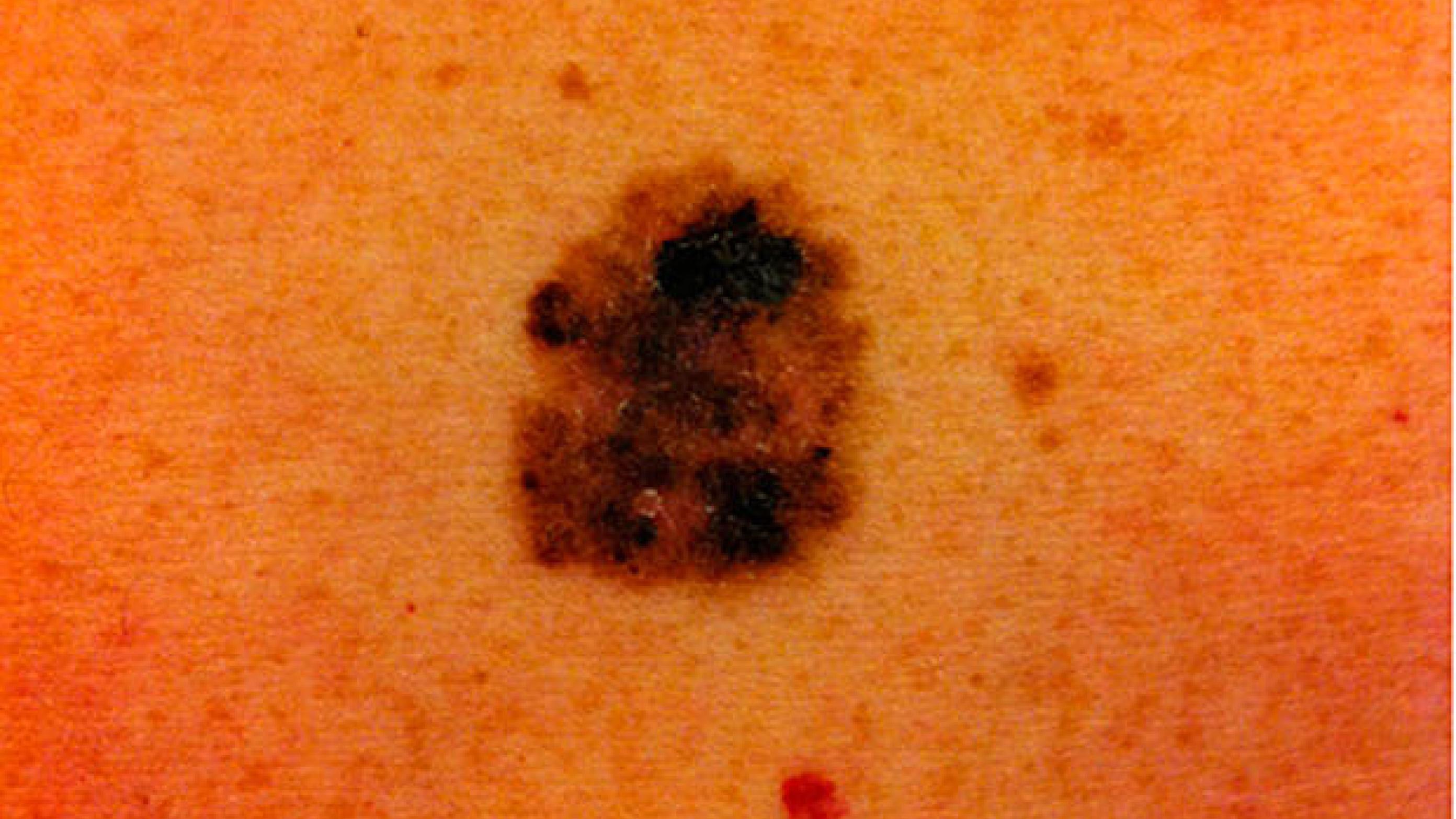 Kutant melanom. (Foto: Pia Sjøgren).