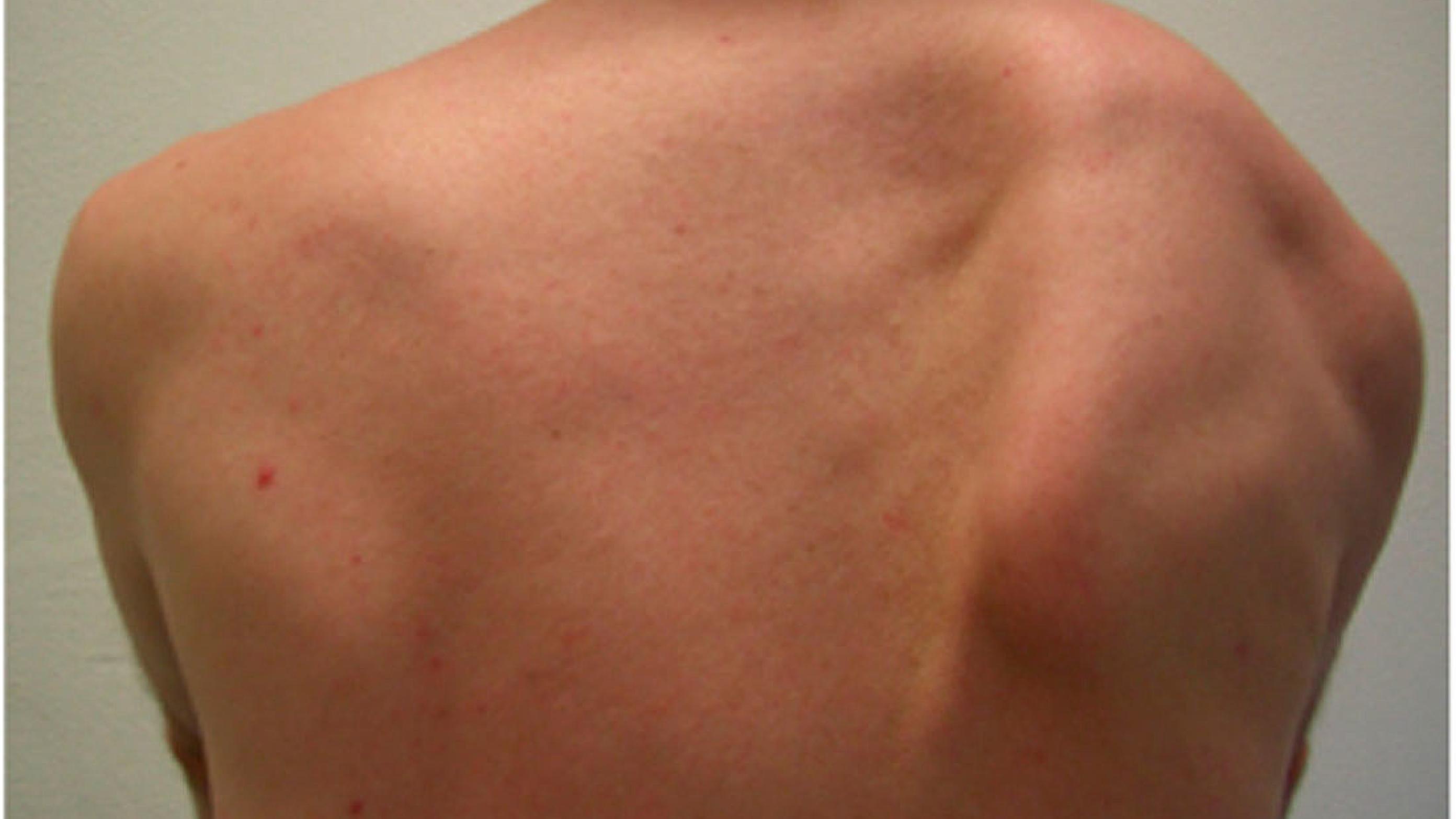 Voksen mandlig patient med højresidig englevinge forårsaget af serratus anterior-insufficiens under forsøg på løft af armen.